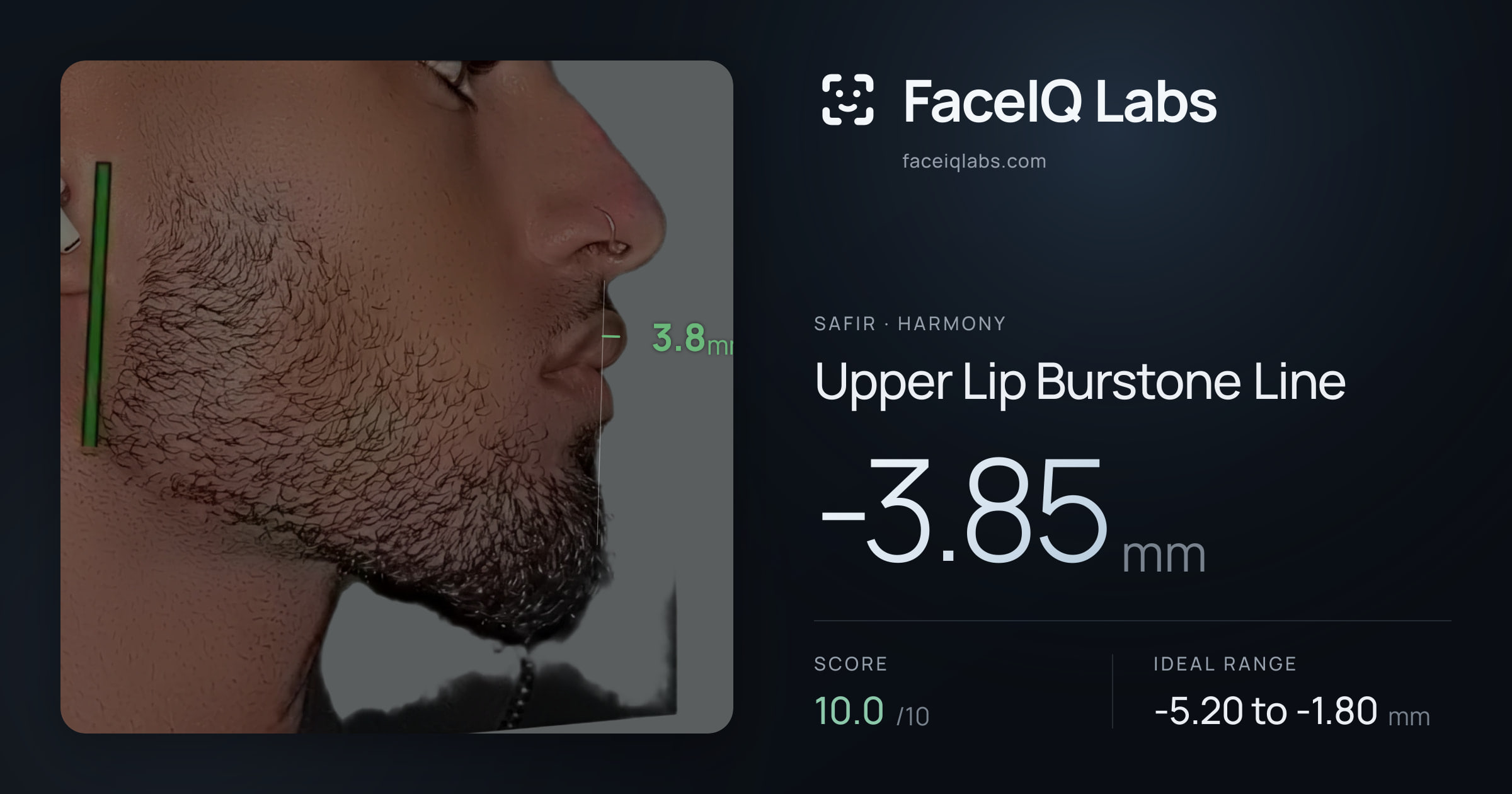 Safir Upper Lip Burstone Line: -3.87mm, drawn on the photo