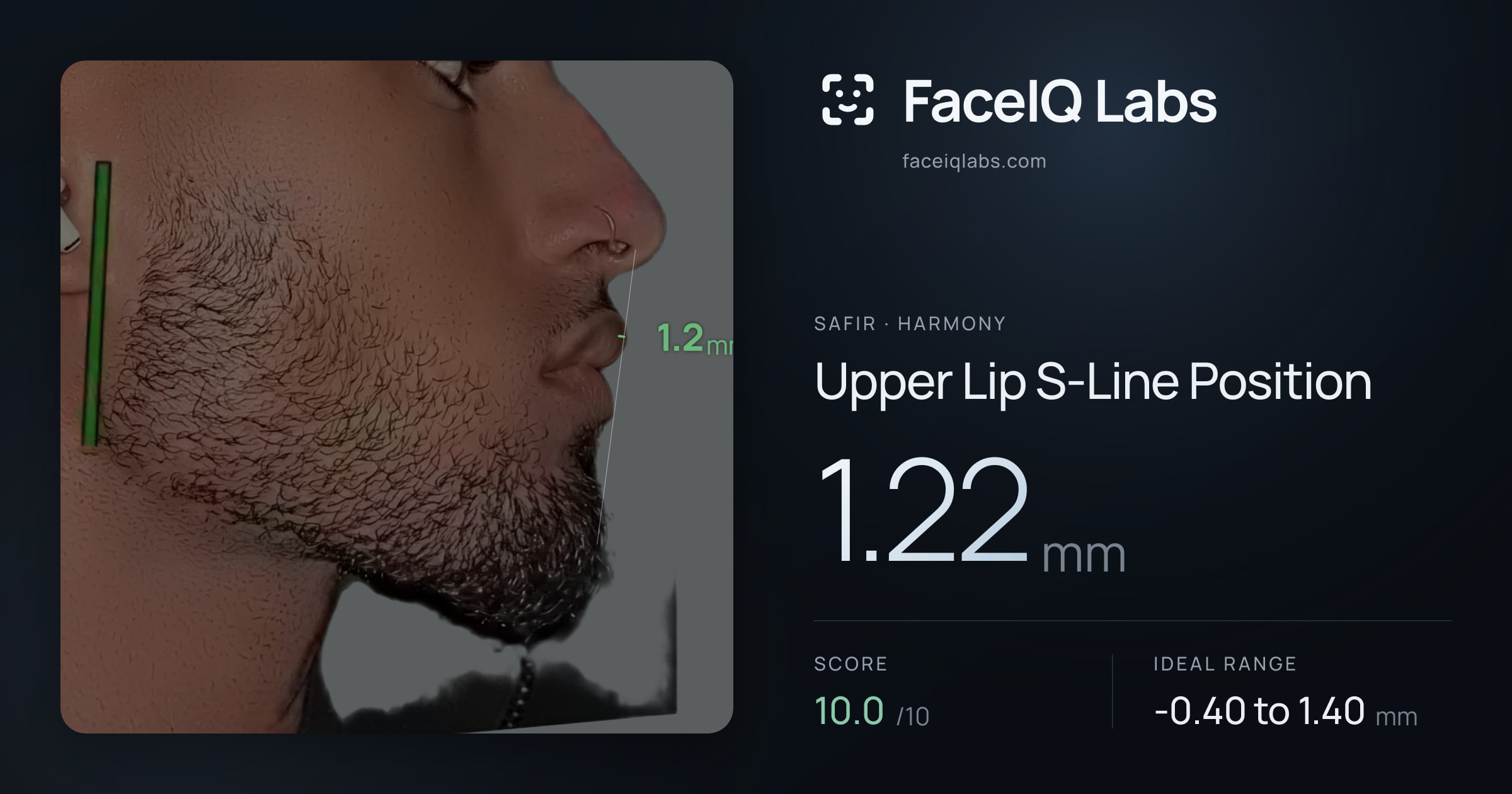 Safir Upper Lip S-Line Position: 1.23mm, drawn on the photo