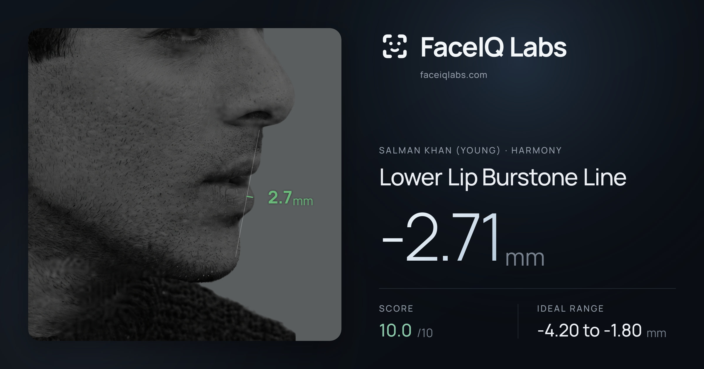Salman Khan (Young) Lower Lip Burstone Line: -2.71mm, drawn on the photo