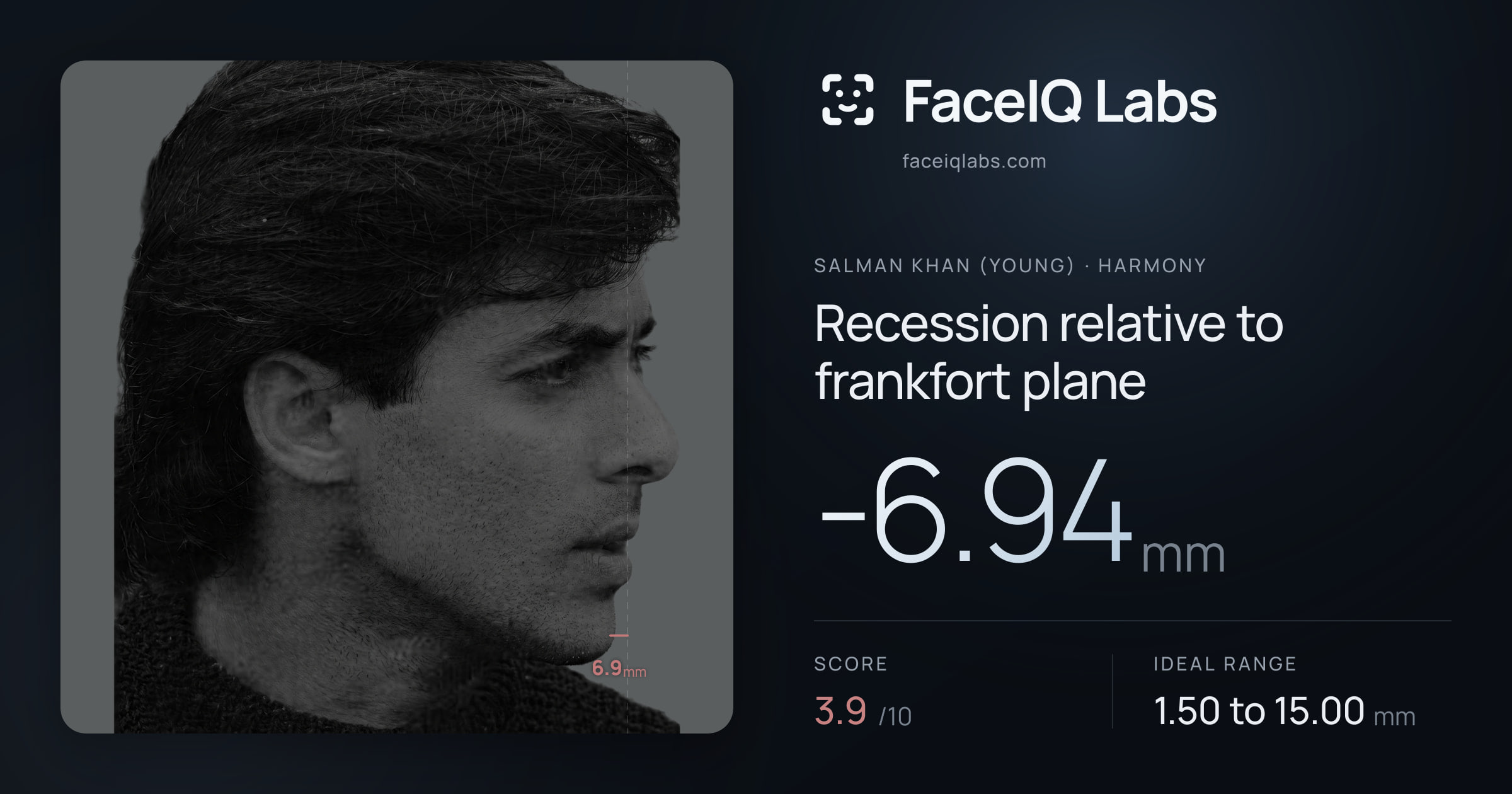 Salman Khan (Young) Recession relative to frankfort plane: -6.94mm, drawn on the photo