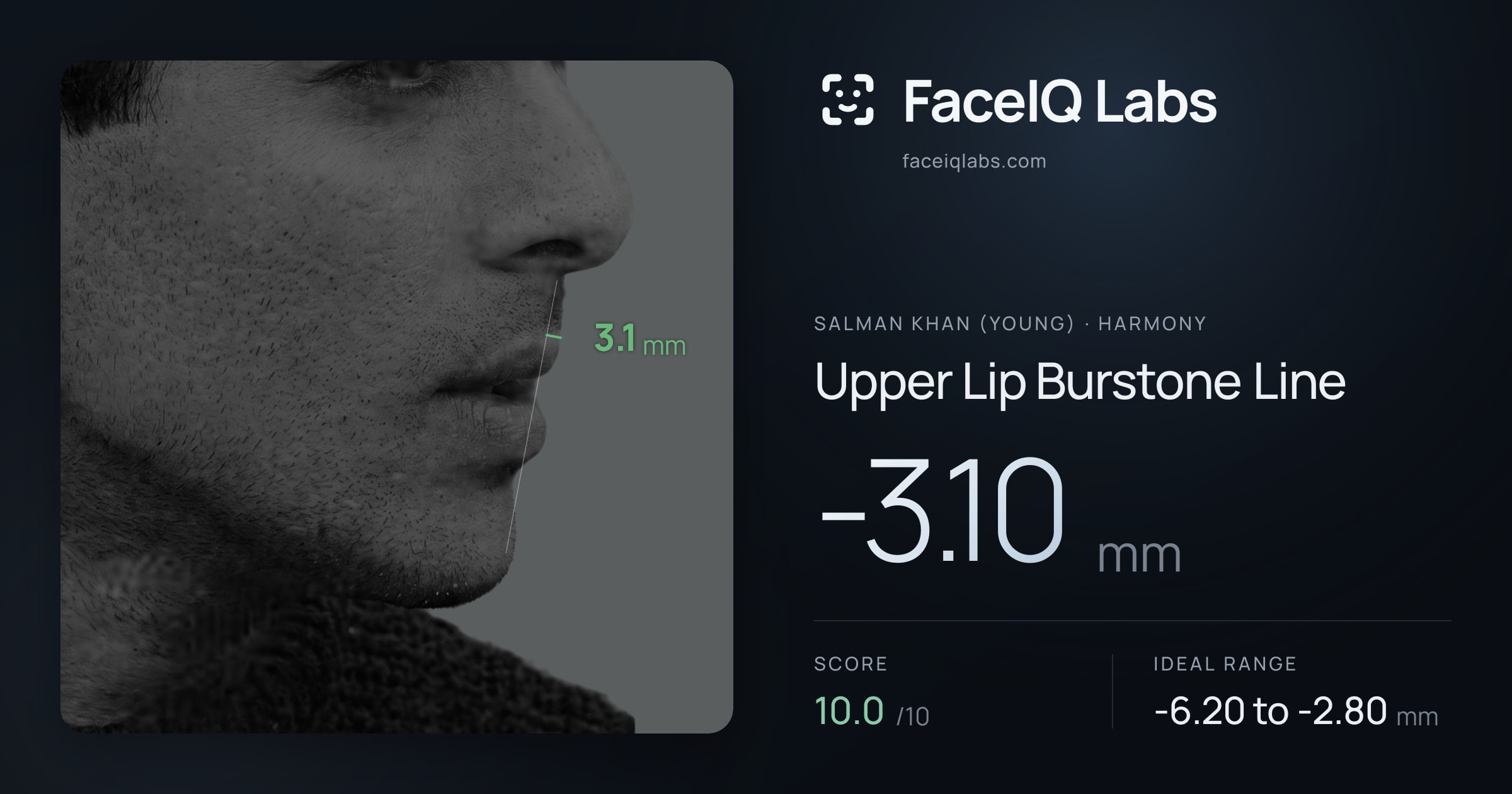 Salman Khan (Young) Upper Lip Burstone Line: -3.10mm, drawn on the photo