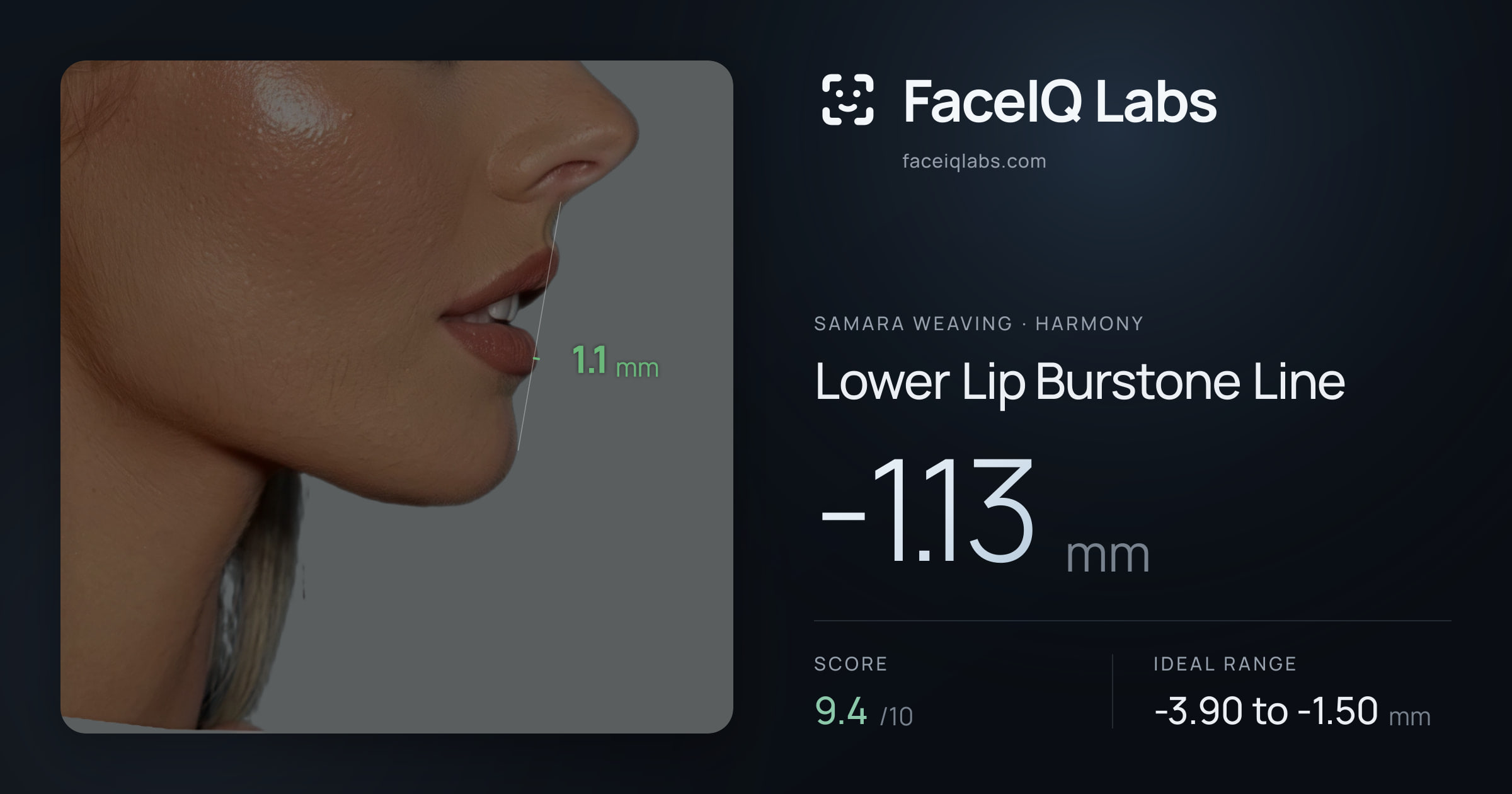 Samara Weaving Lower Lip Burstone Line: -1.13mm, drawn on the photo