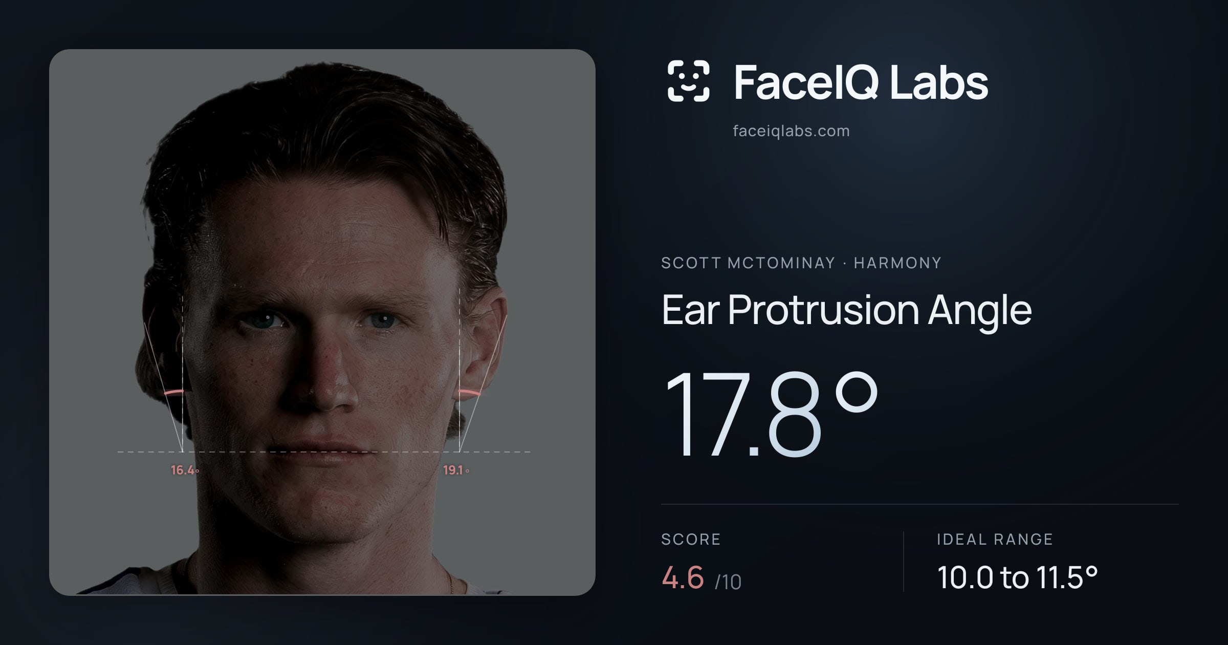 Scott Mctominay Ear Protrusion Angle: 17.8°, drawn on the photo