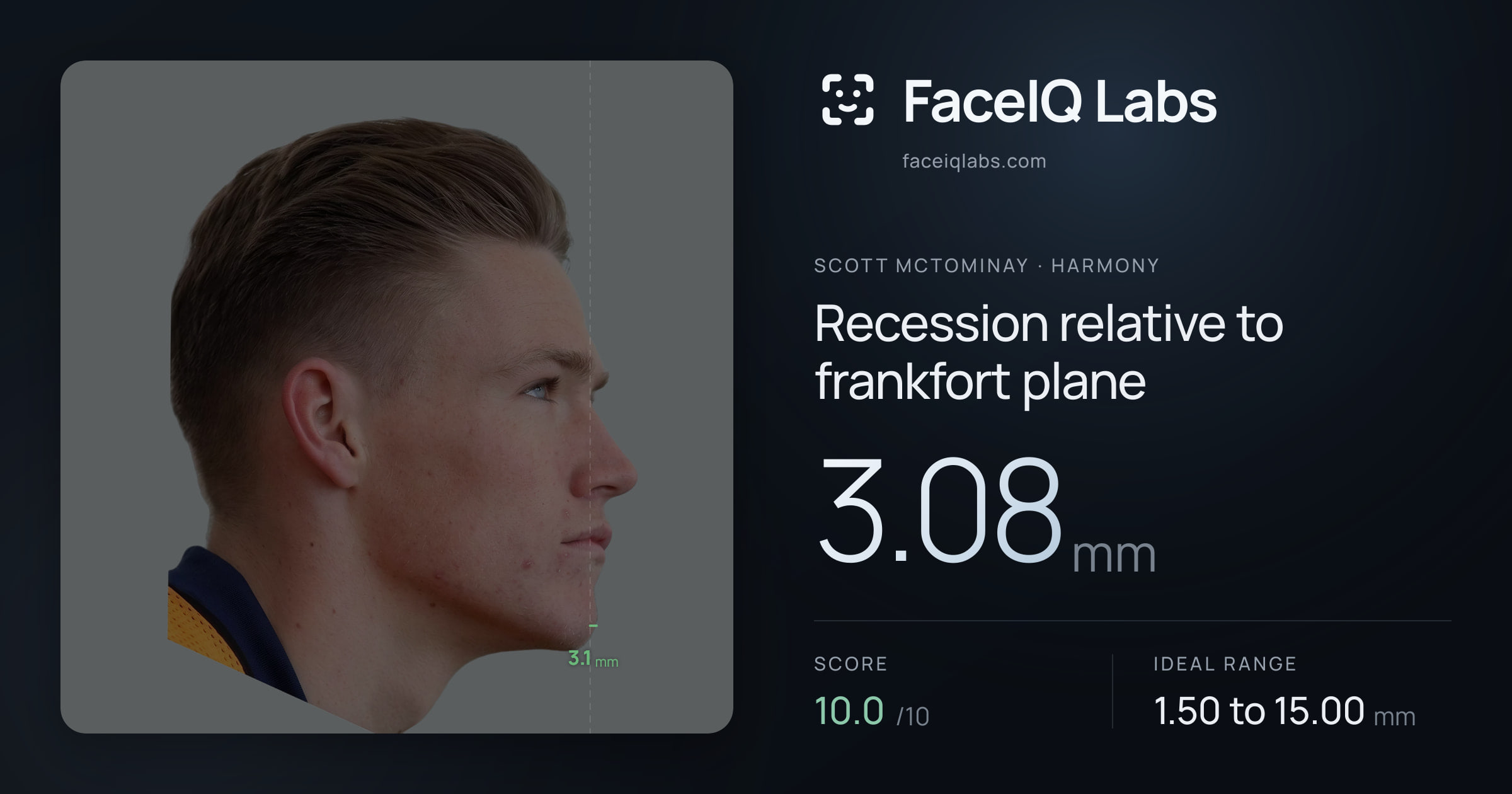 Scott Mctominay Recession relative to frankfort plane: 3.08mm, drawn on the photo