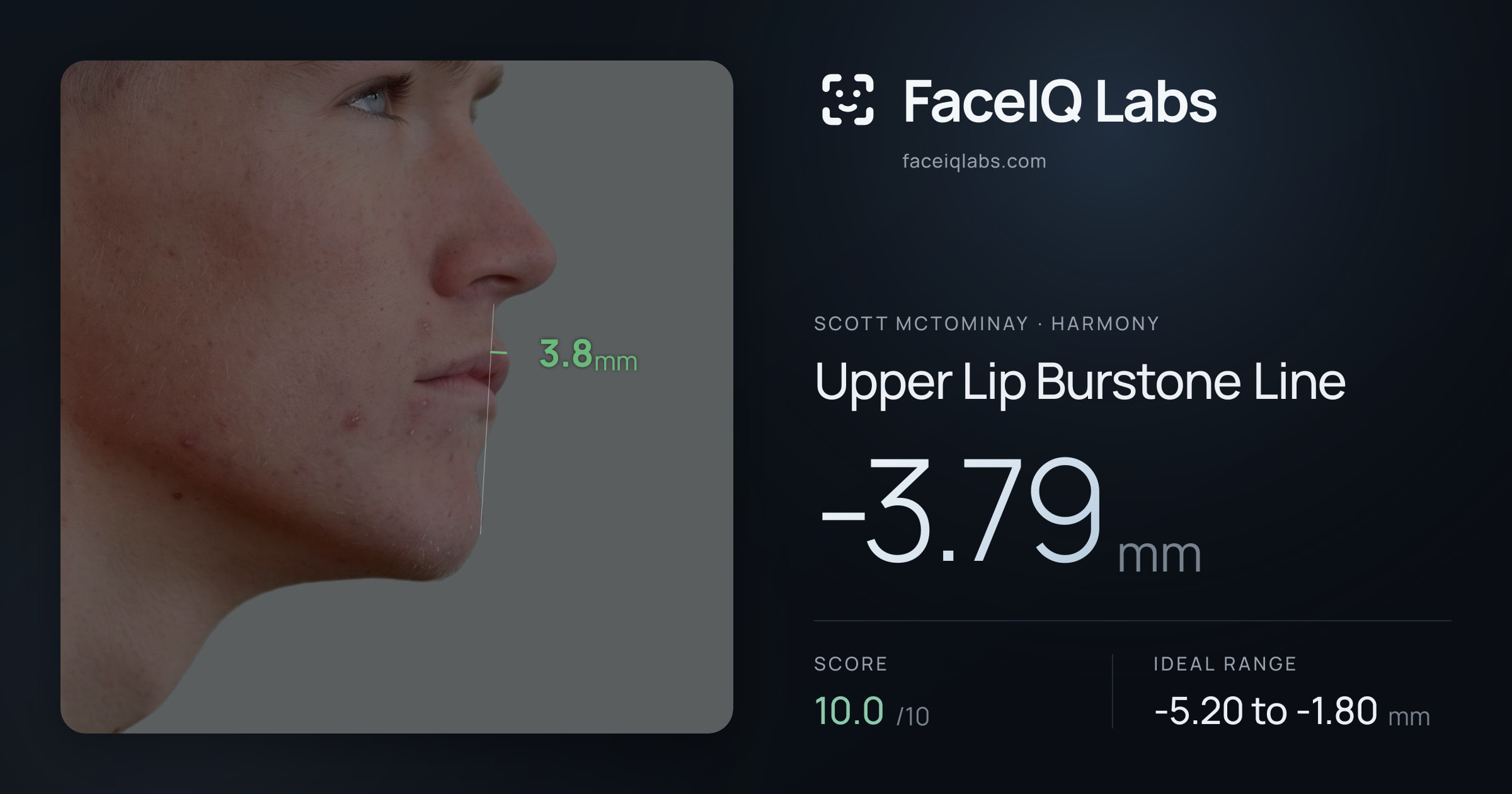 Scott Mctominay Upper Lip Burstone Line: -3.79mm, drawn on the photo