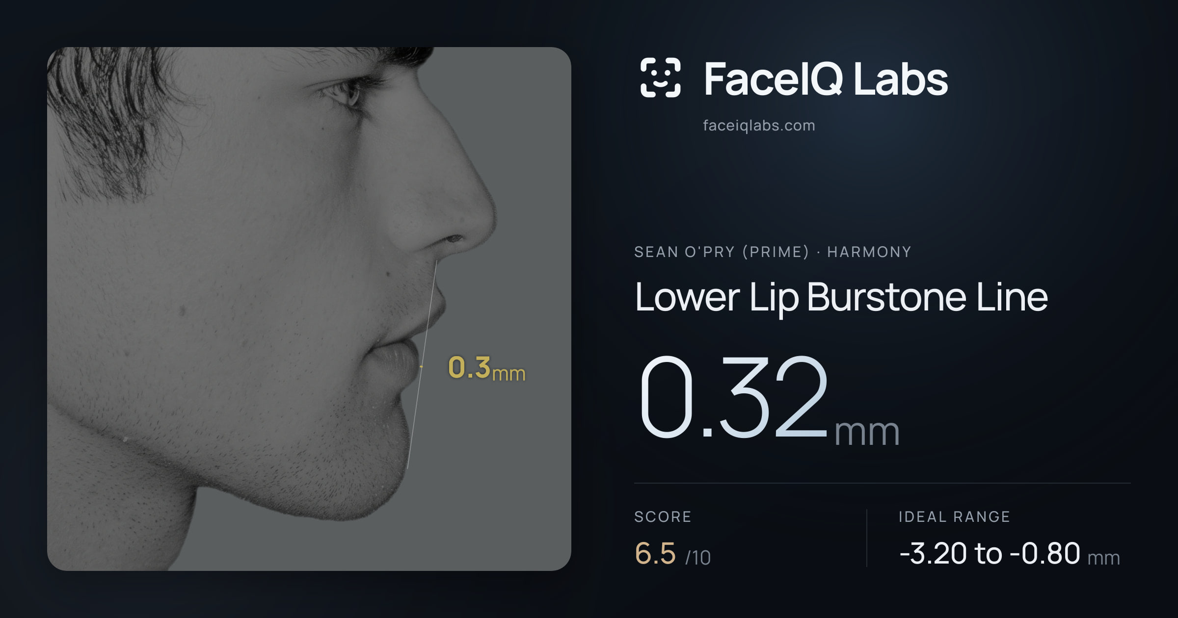 Sean O'Pry (Prime) Lower Lip Burstone Line: 0.32mm, drawn on the photo