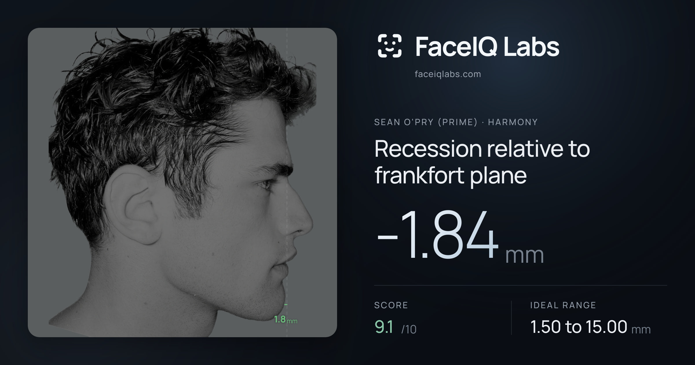 Sean O'Pry (Prime) Recession relative to frankfort plane: -1.84mm, drawn on the photo