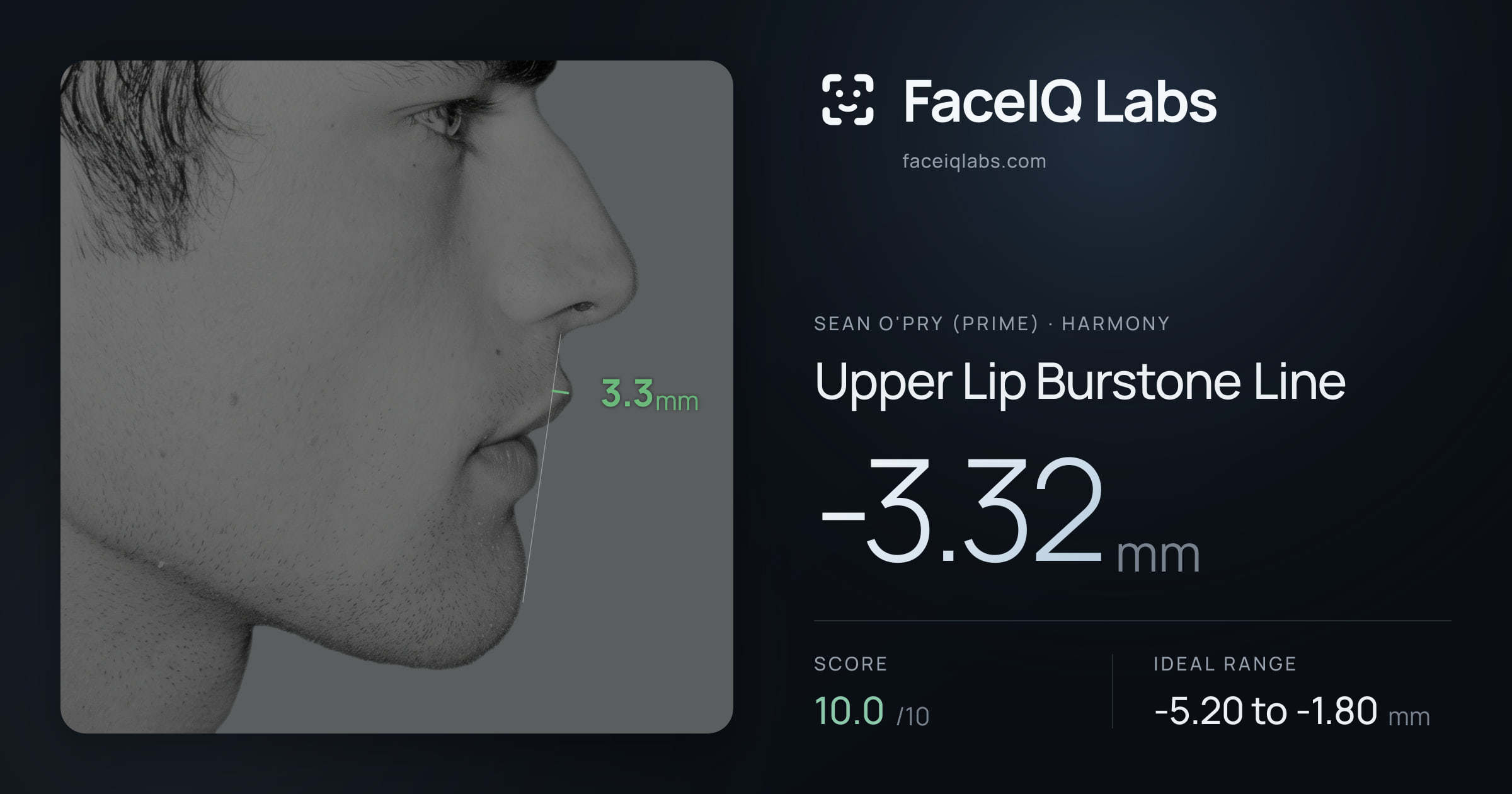 Sean O'Pry (Prime) Upper Lip Burstone Line: -3.32mm, drawn on the photo