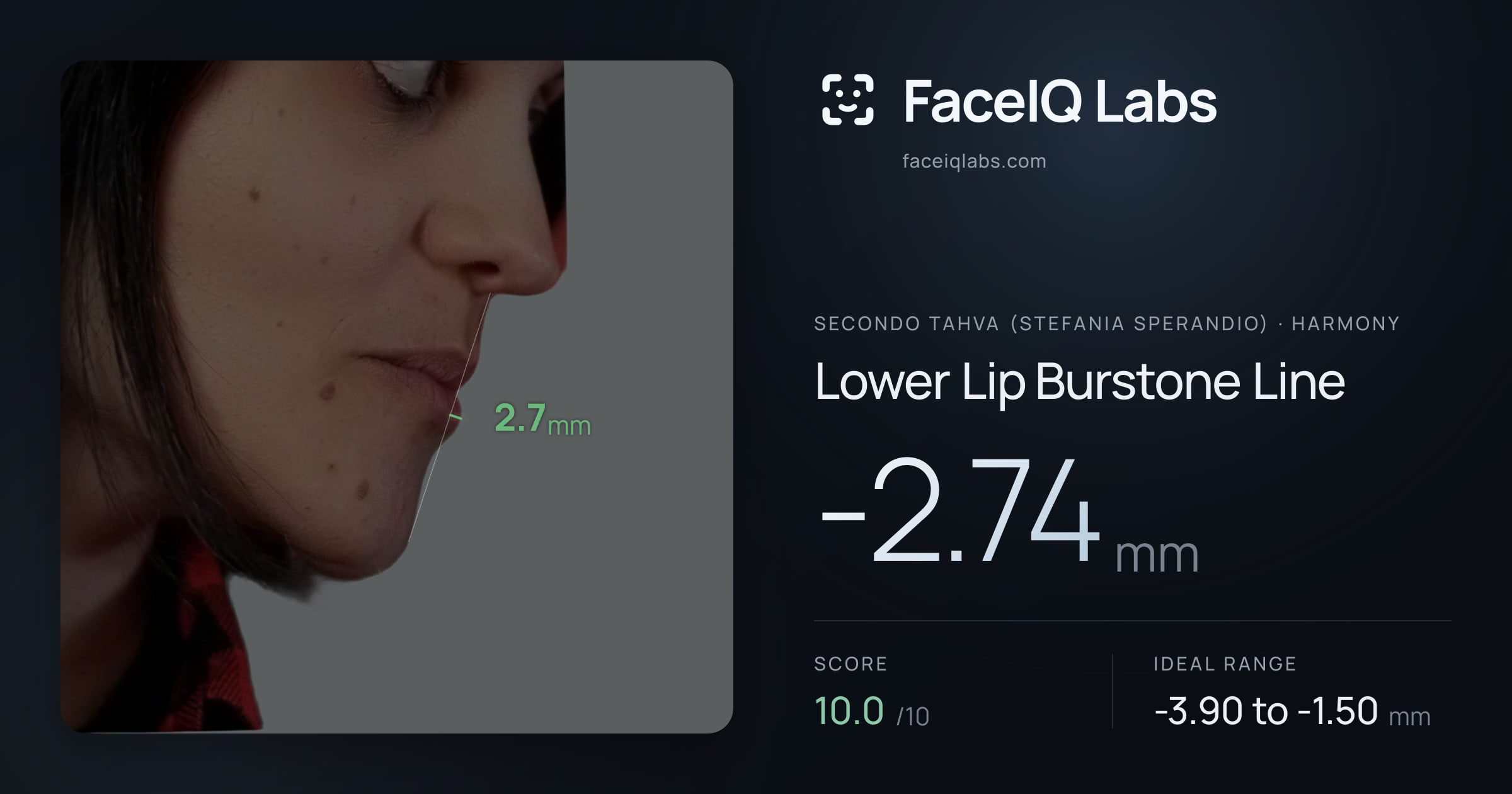 Secondo Tahva (Stefania Sperandio) Lower Lip Burstone Line: -2.74mm, drawn on the photo
