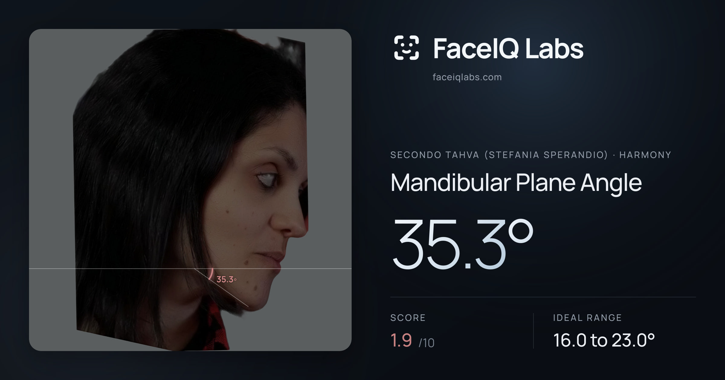 Secondo Tahva (Stefania Sperandio) Mandibular Plane Angle: 35.3°, drawn on the photo