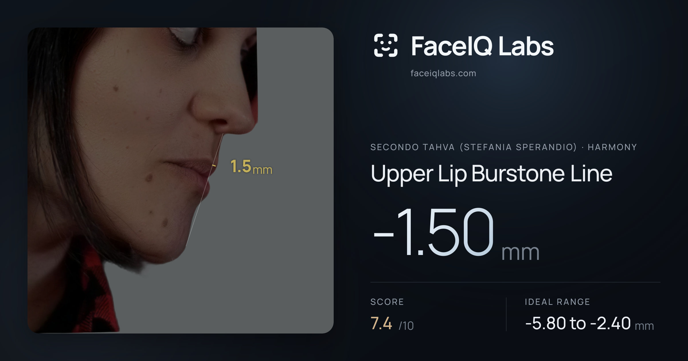 Secondo Tahva (Stefania Sperandio) Upper Lip Burstone Line: -1.50mm, drawn on the photo