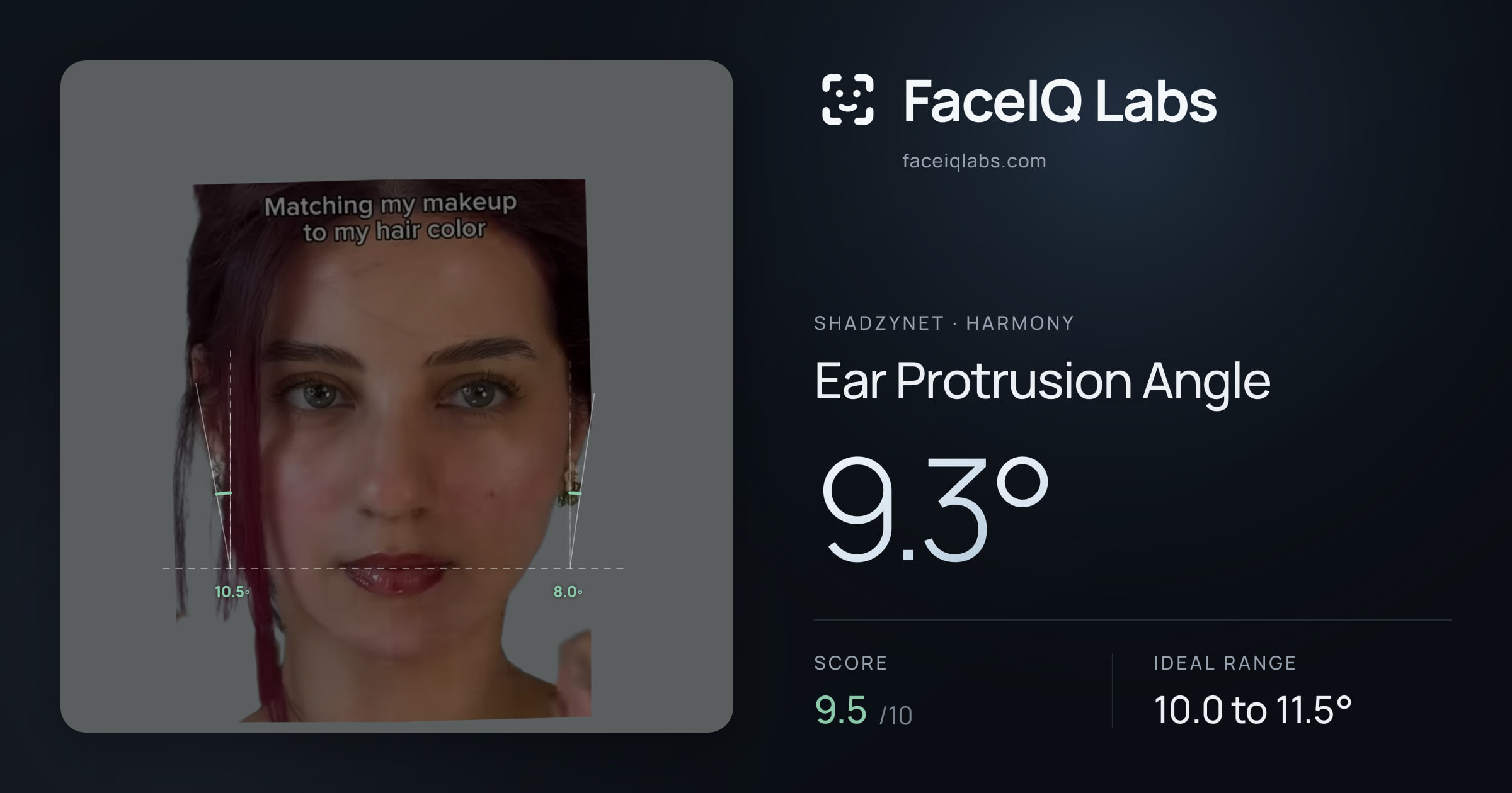Shadzynet Ear Protrusion Angle: 9.3°, drawn on the photo