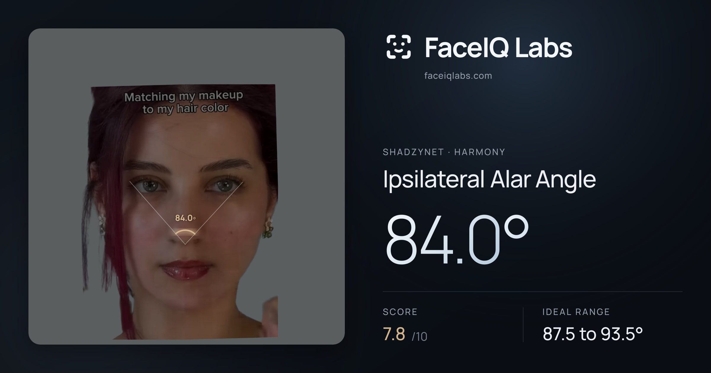 Shadzynet Ipsilateral Alar Angle: 84.0°, drawn on the photo