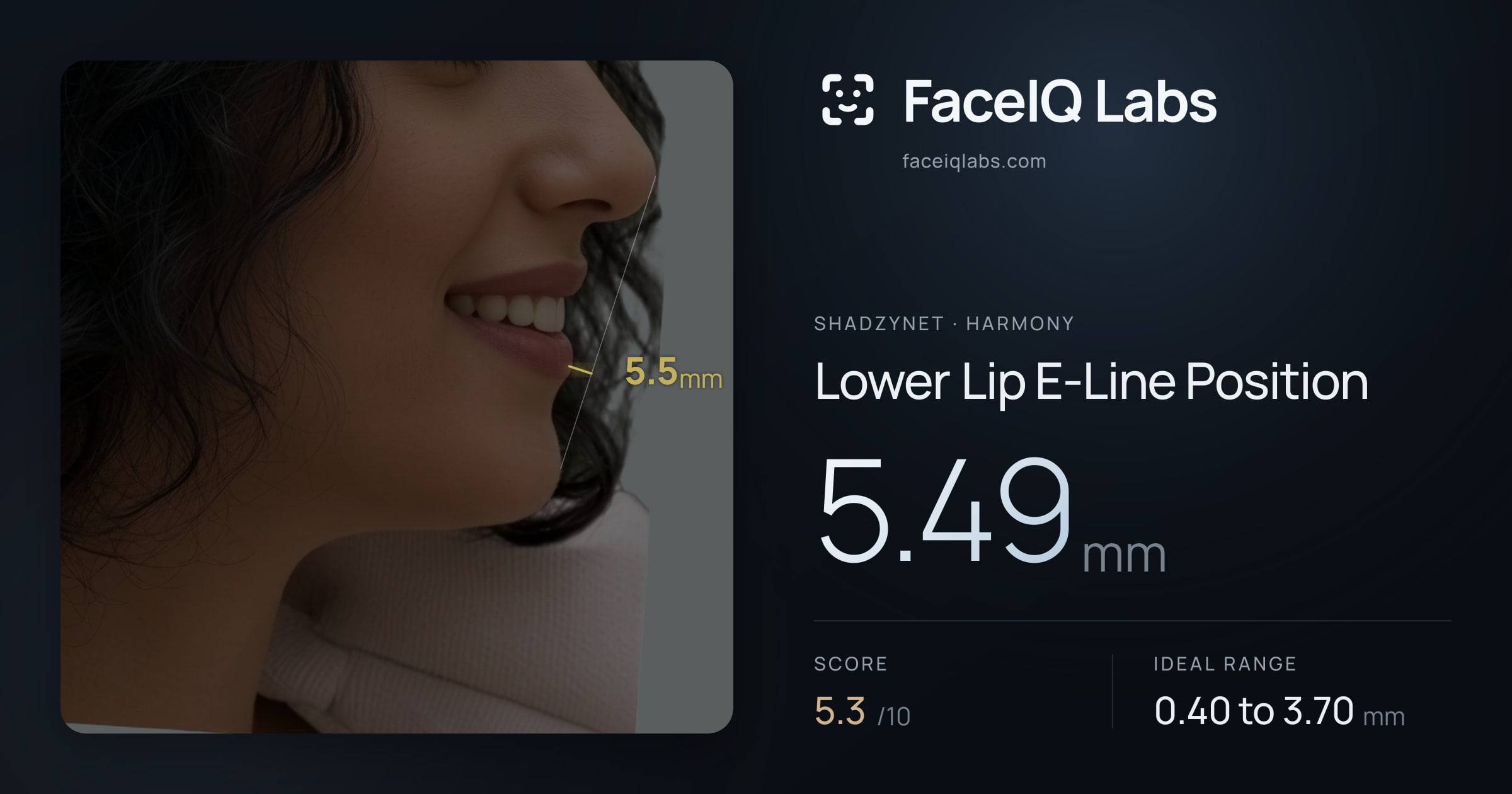 Shadzynet Lower Lip E-Line Position: 5.49mm, drawn on the photo