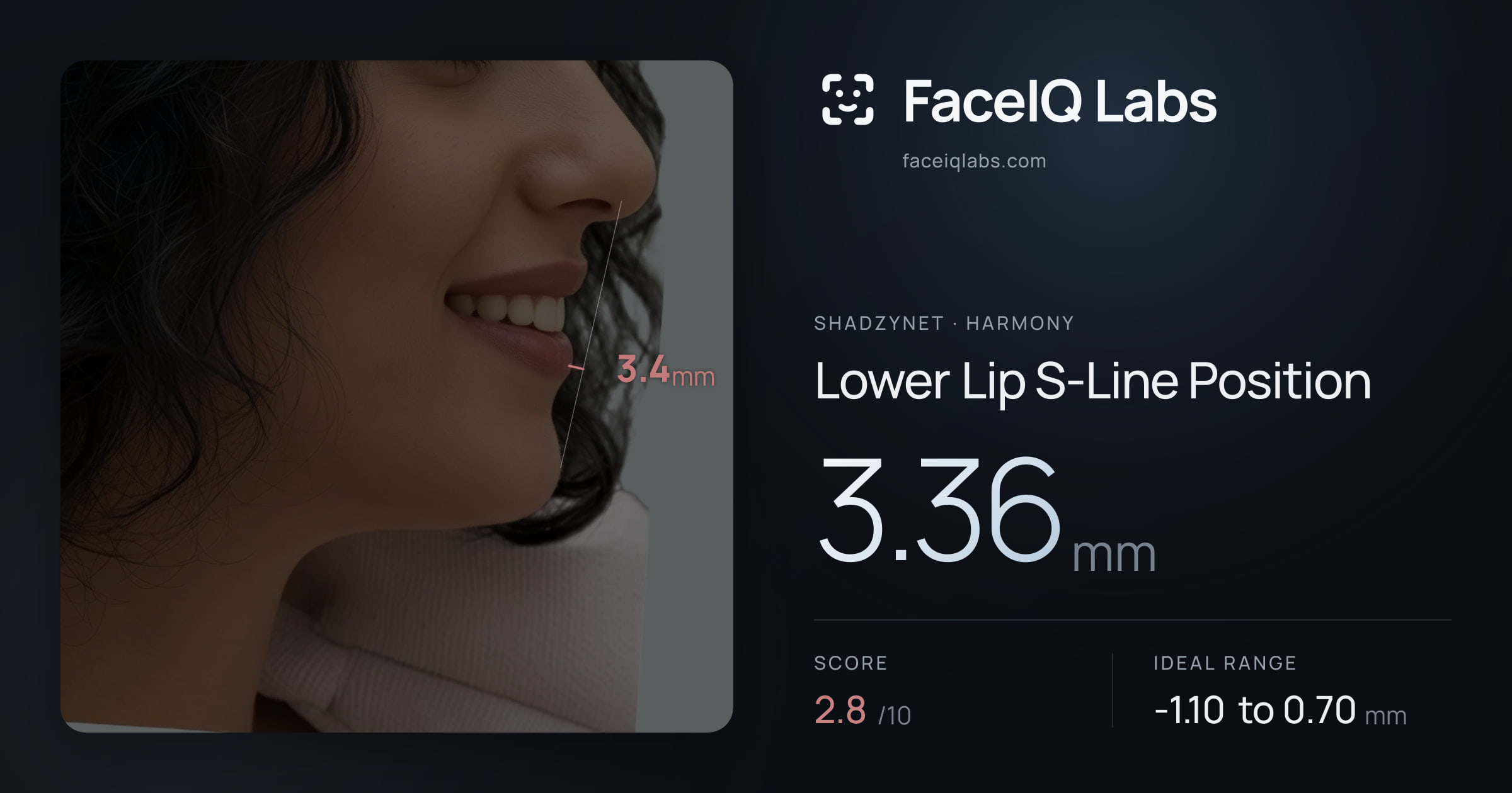 Shadzynet Lower Lip S-Line Position: 3.36mm, drawn on the photo