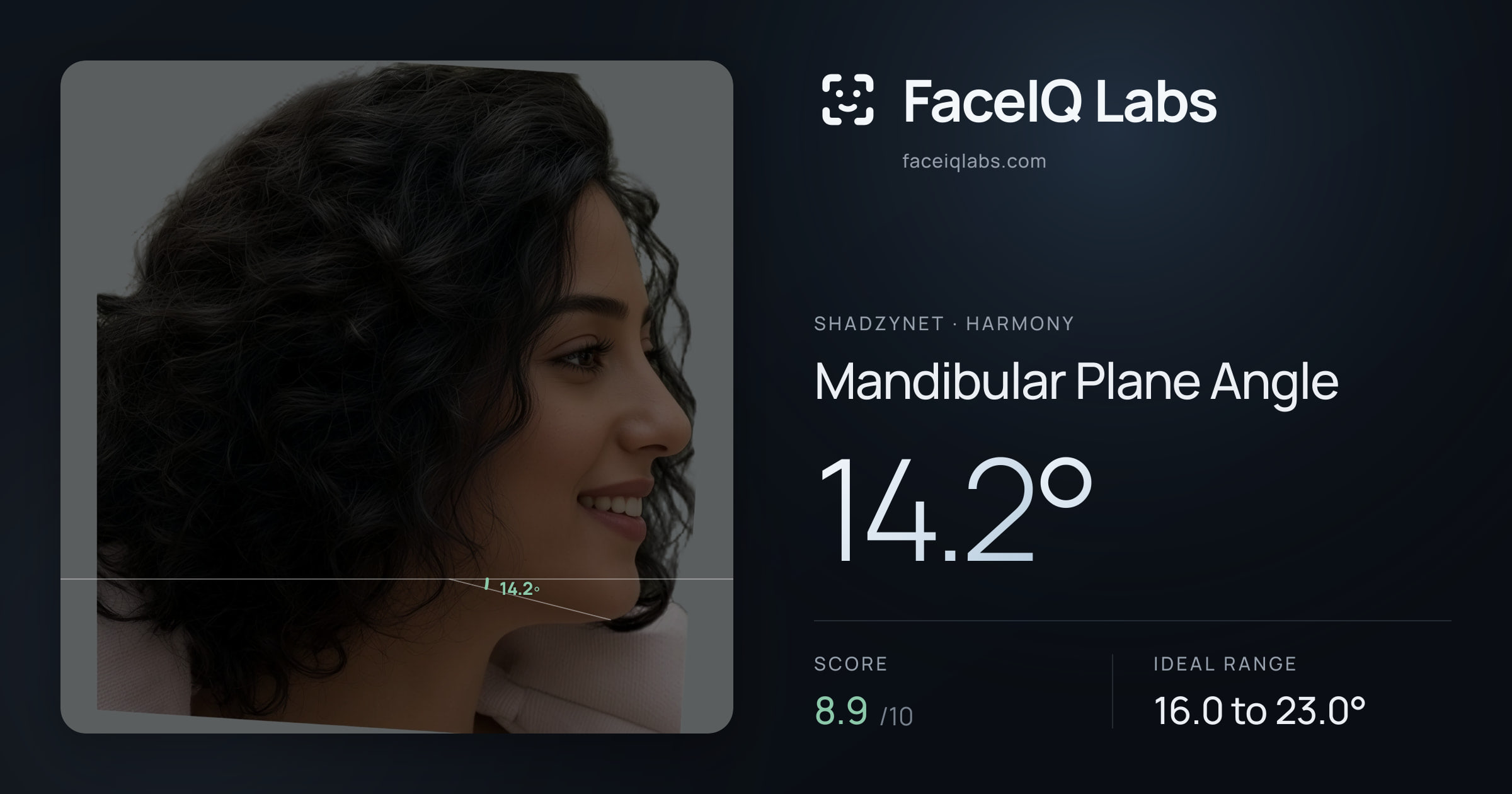 Shadzynet Mandibular Plane Angle: 14.2°, drawn on the photo