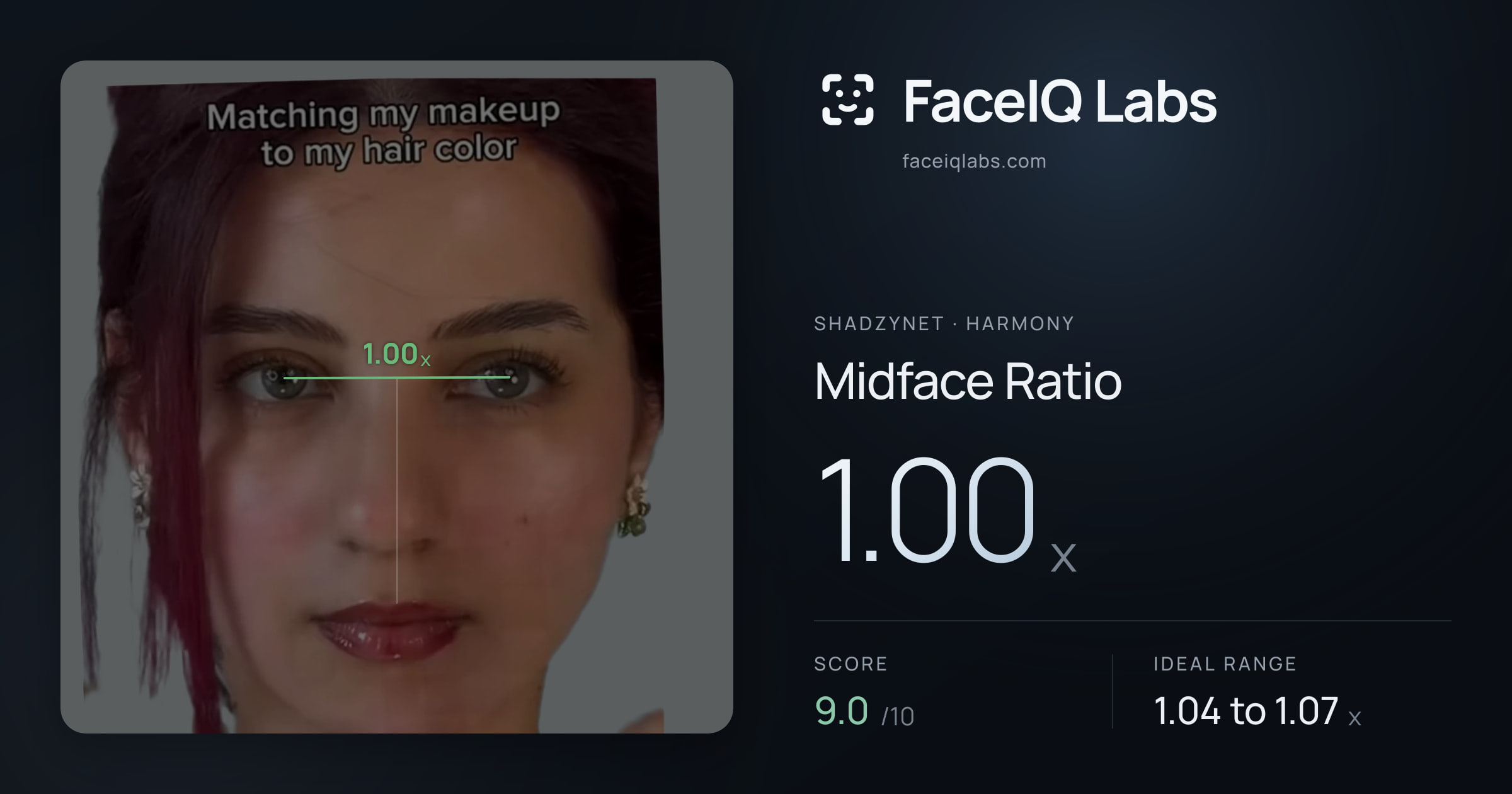 Shadzynet Midface Ratio: 1.00x, drawn on the photo