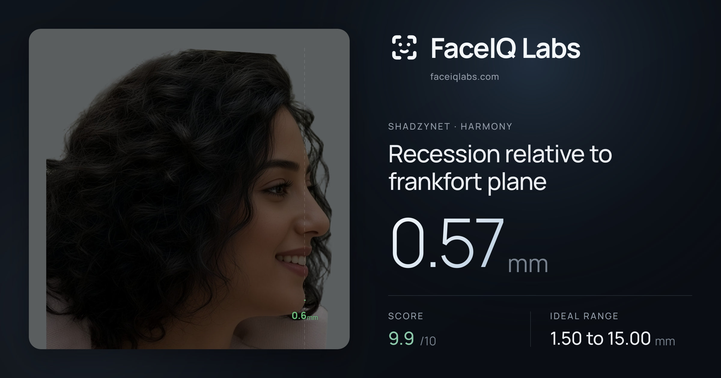 Shadzynet Recession relative to frankfort plane: 0.57mm, drawn on the photo
