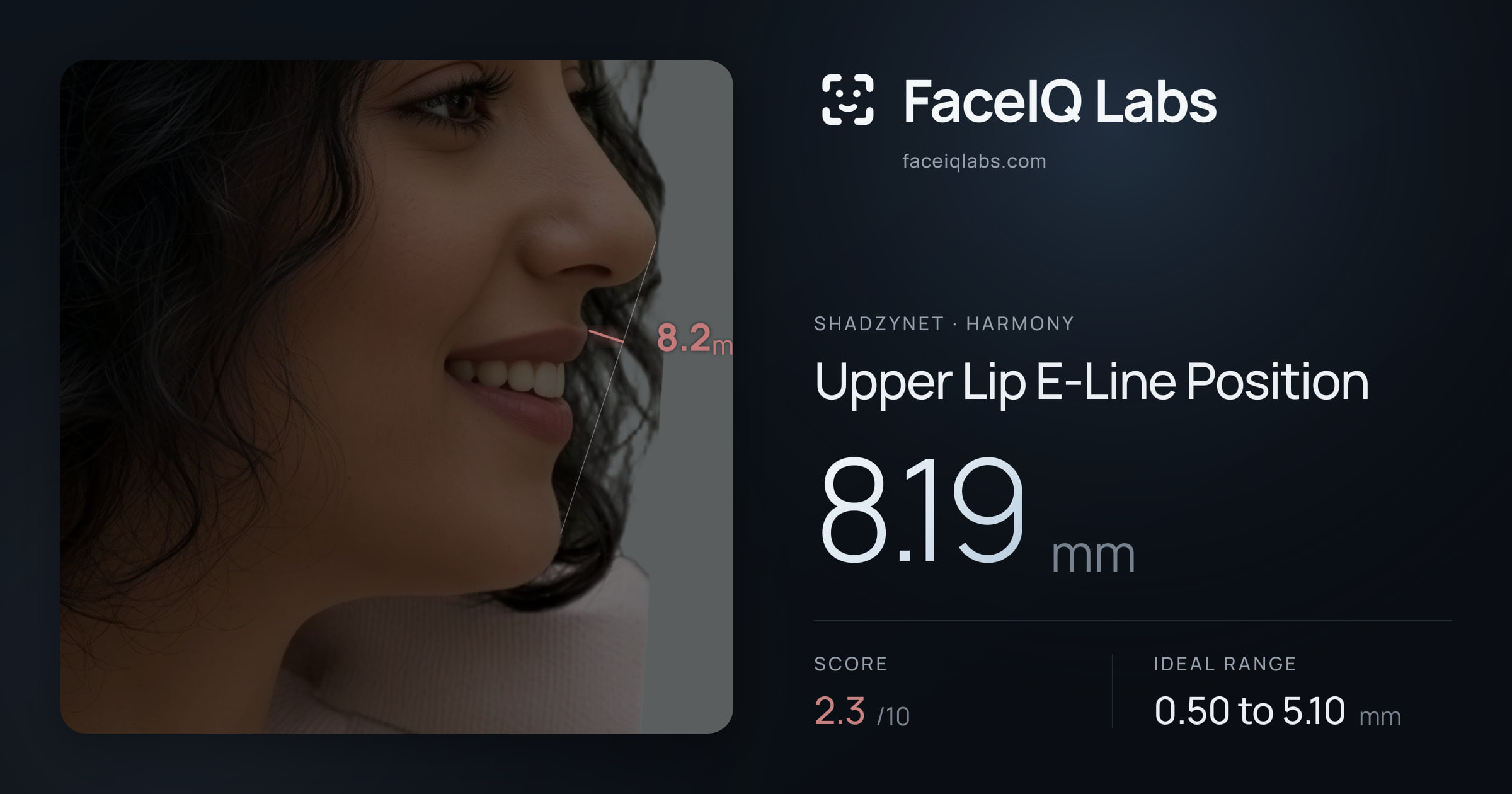 Shadzynet Upper Lip E-Line Position: 8.19mm, drawn on the photo