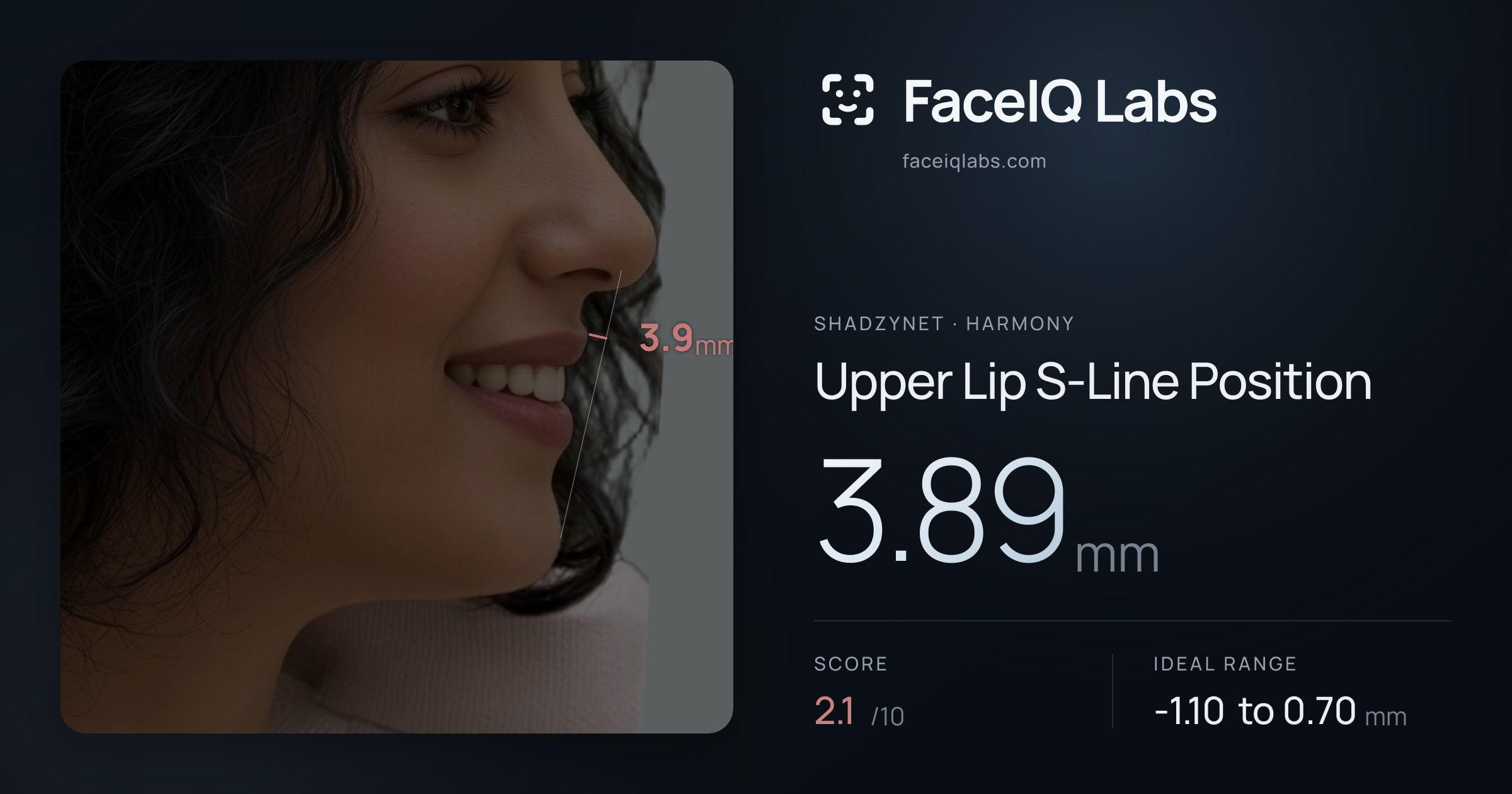 Shadzynet Upper Lip S-Line Position: 3.89mm, drawn on the photo