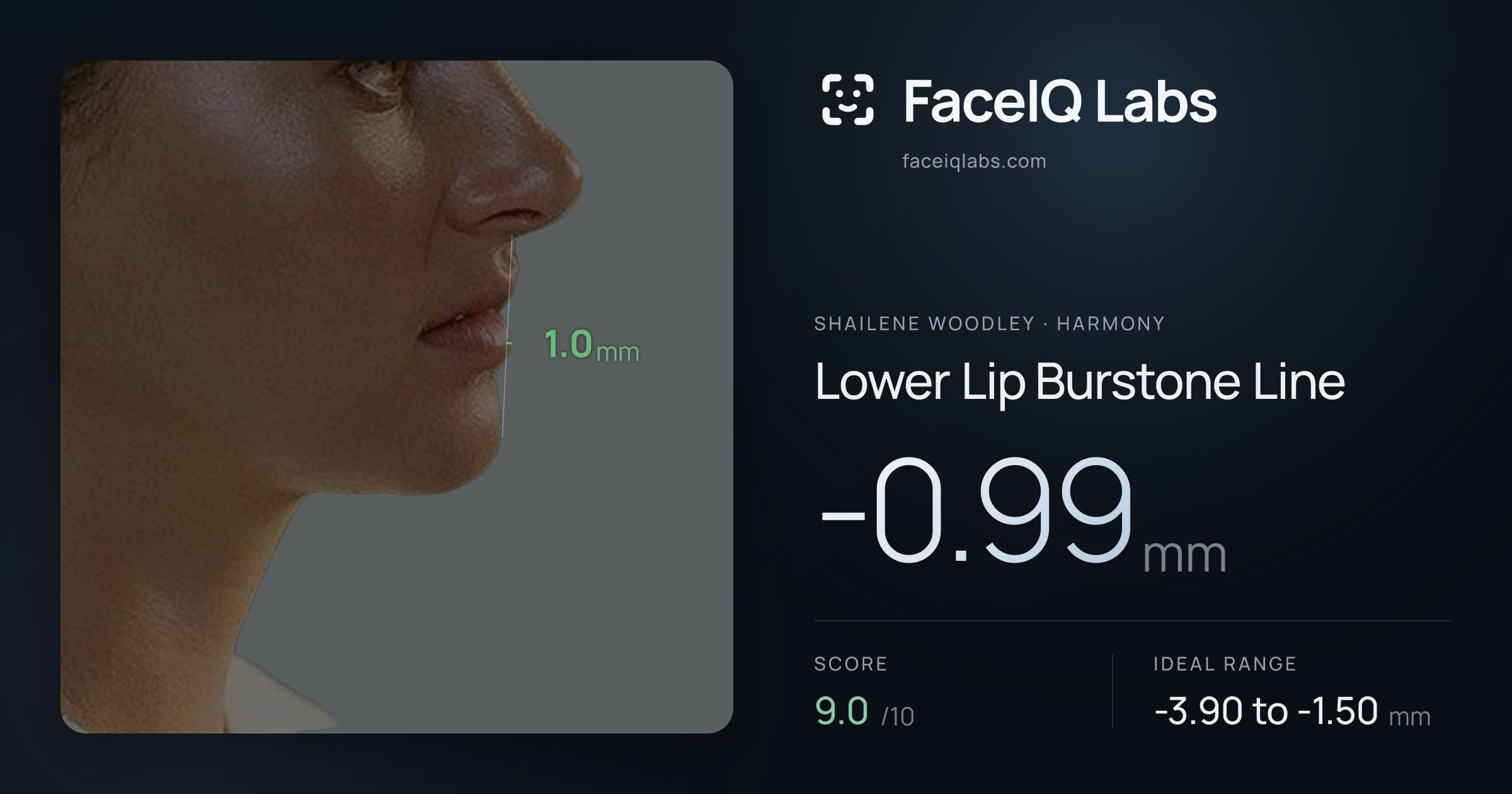 Shailene Woodley Lower Lip Burstone Line: -0.99mm, drawn on the photo