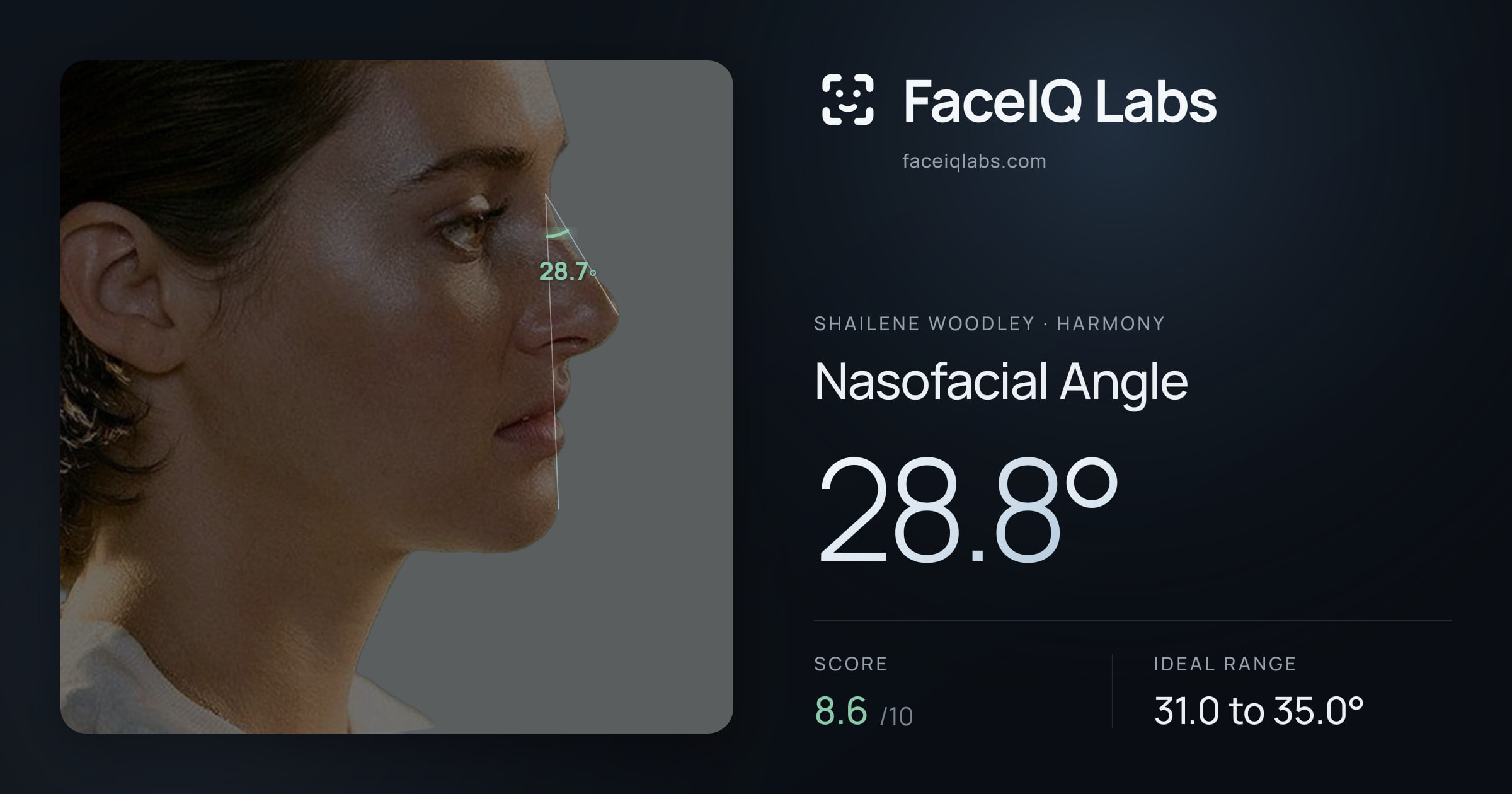 Shailene Woodley Nasofacial Angle: 28.8°, drawn on the photo