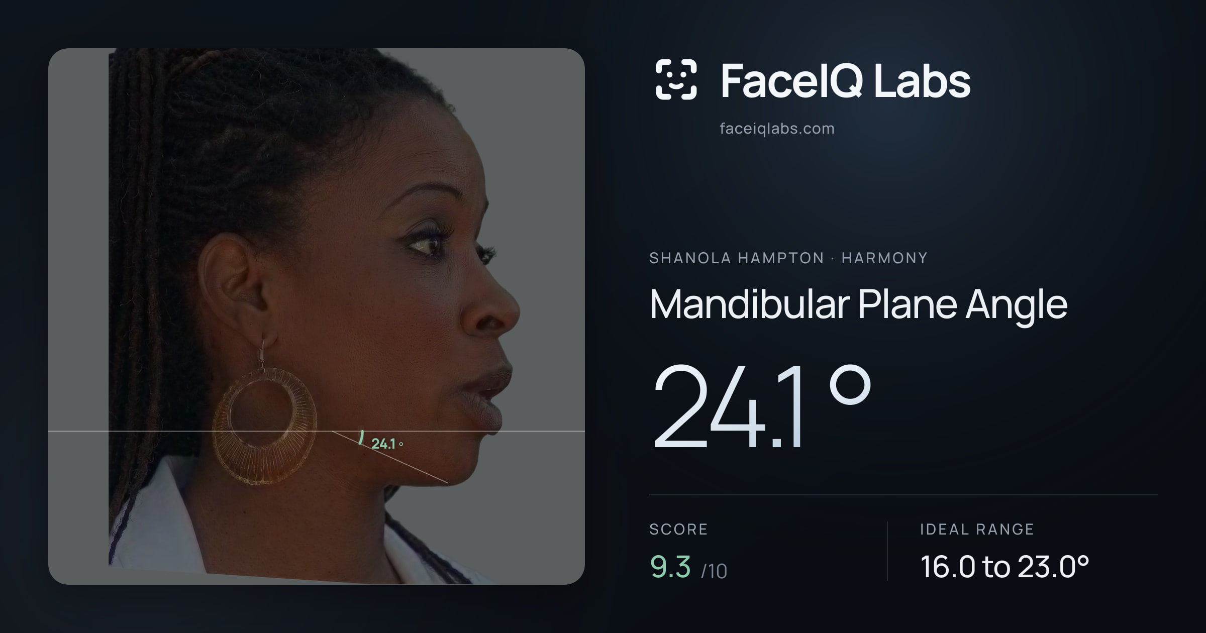 Shanola Hampton Mandibular Plane Angle: 24.1°, drawn on the photo