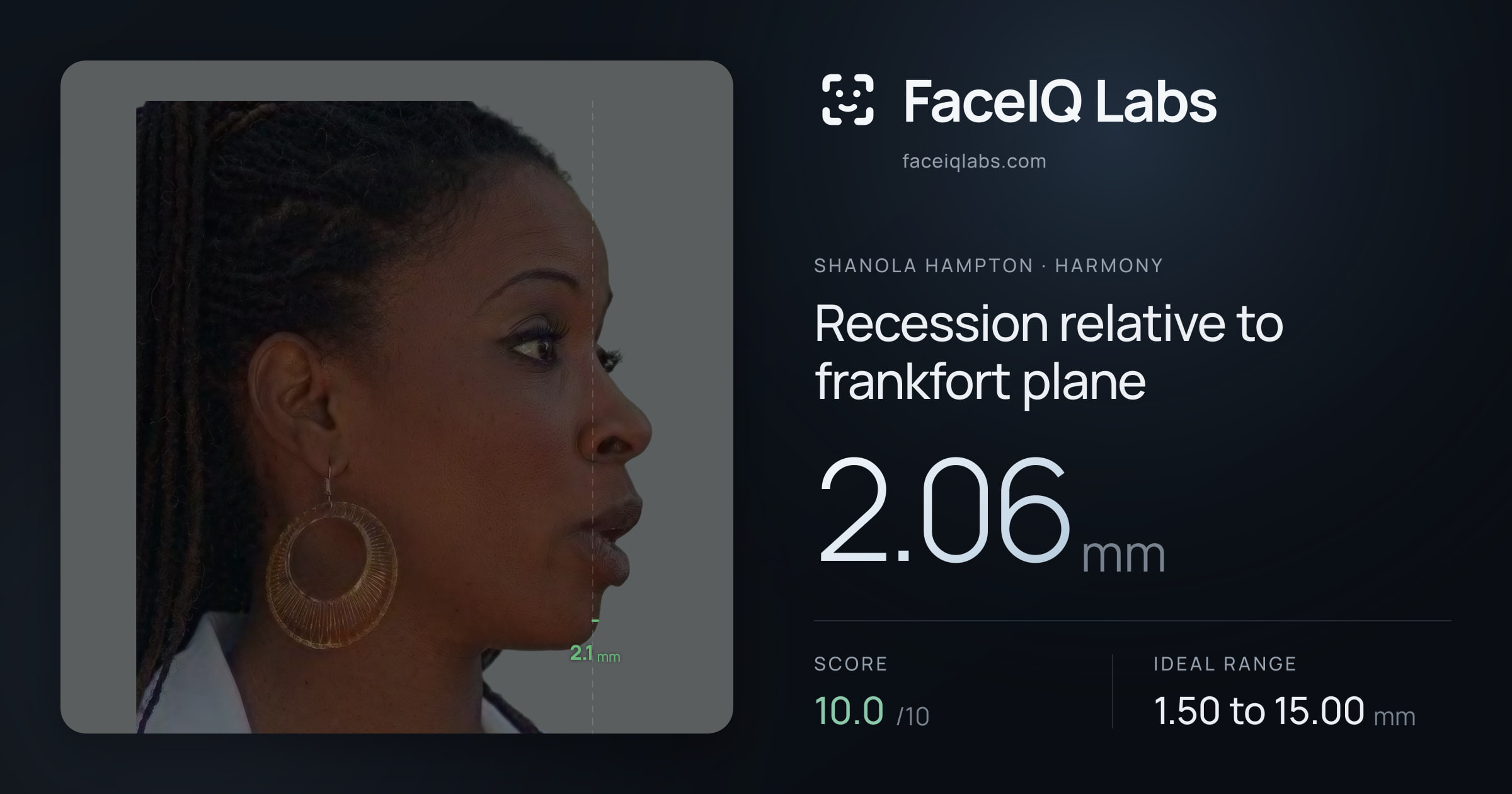 Shanola Hampton Recession relative to frankfort plane: 2.06mm, drawn on the photo