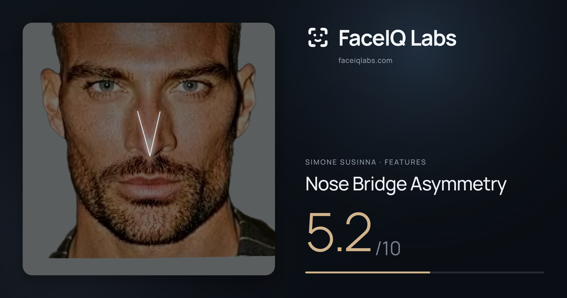 Simone Susinna Nose Bridge Asymmetry: 5.2/10, drawn on the photo