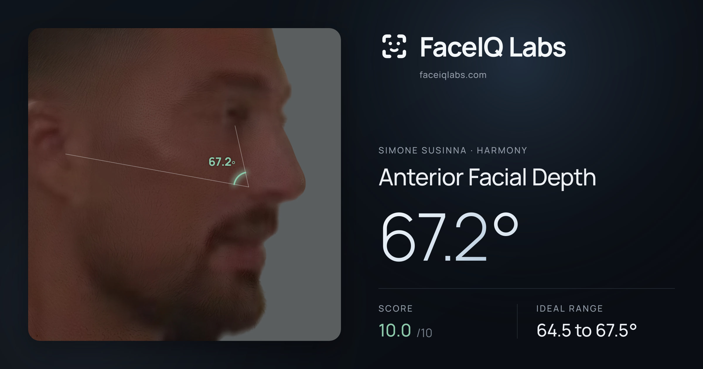 Simone Susinna Anterior Facial Depth: 67.2°, drawn on the photo