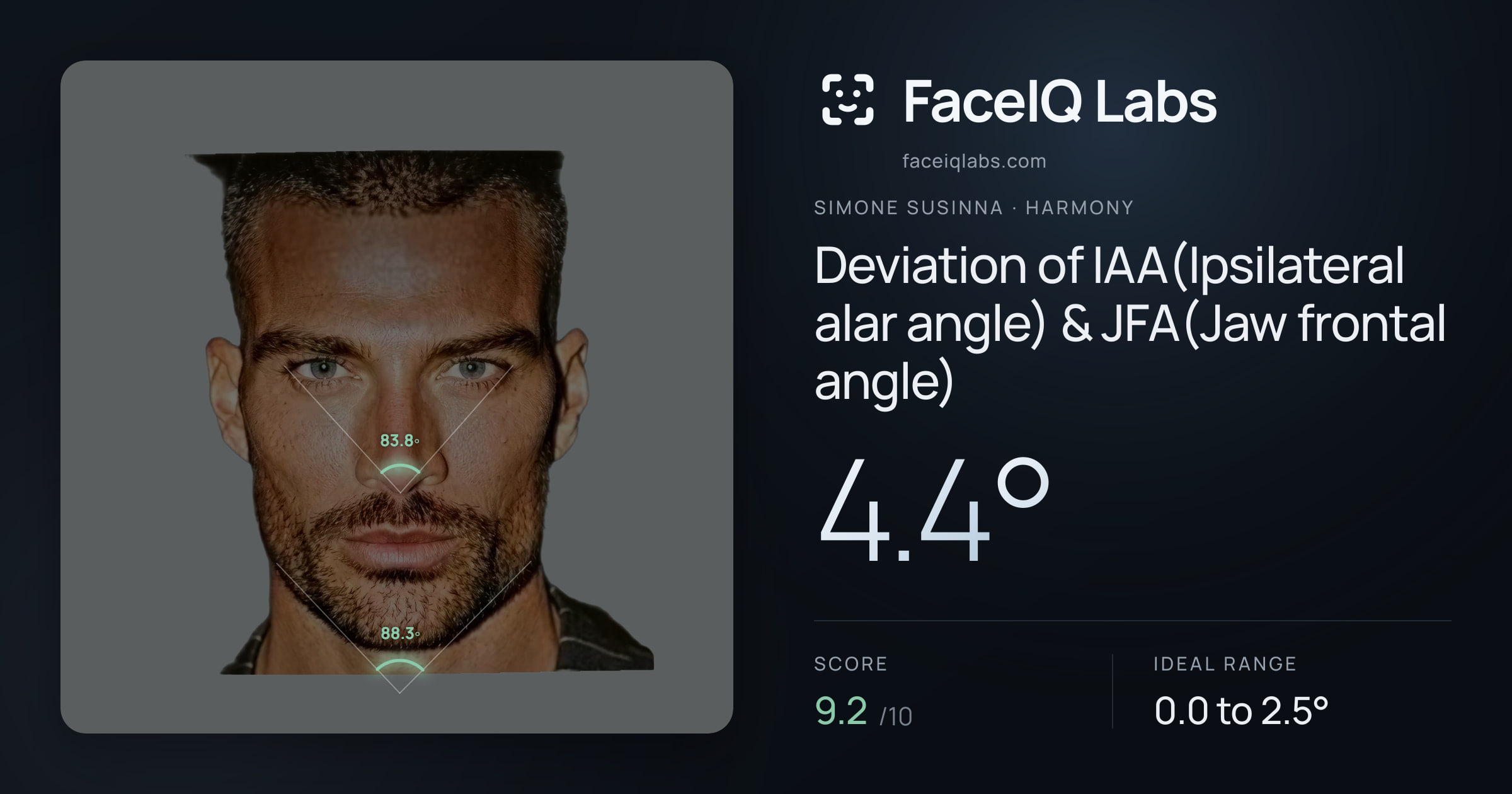 Simone Susinna Deviation of IAA(Ipsilateral alar angle) & JFA(Jaw frontal angle): 4.4°, drawn on the photo