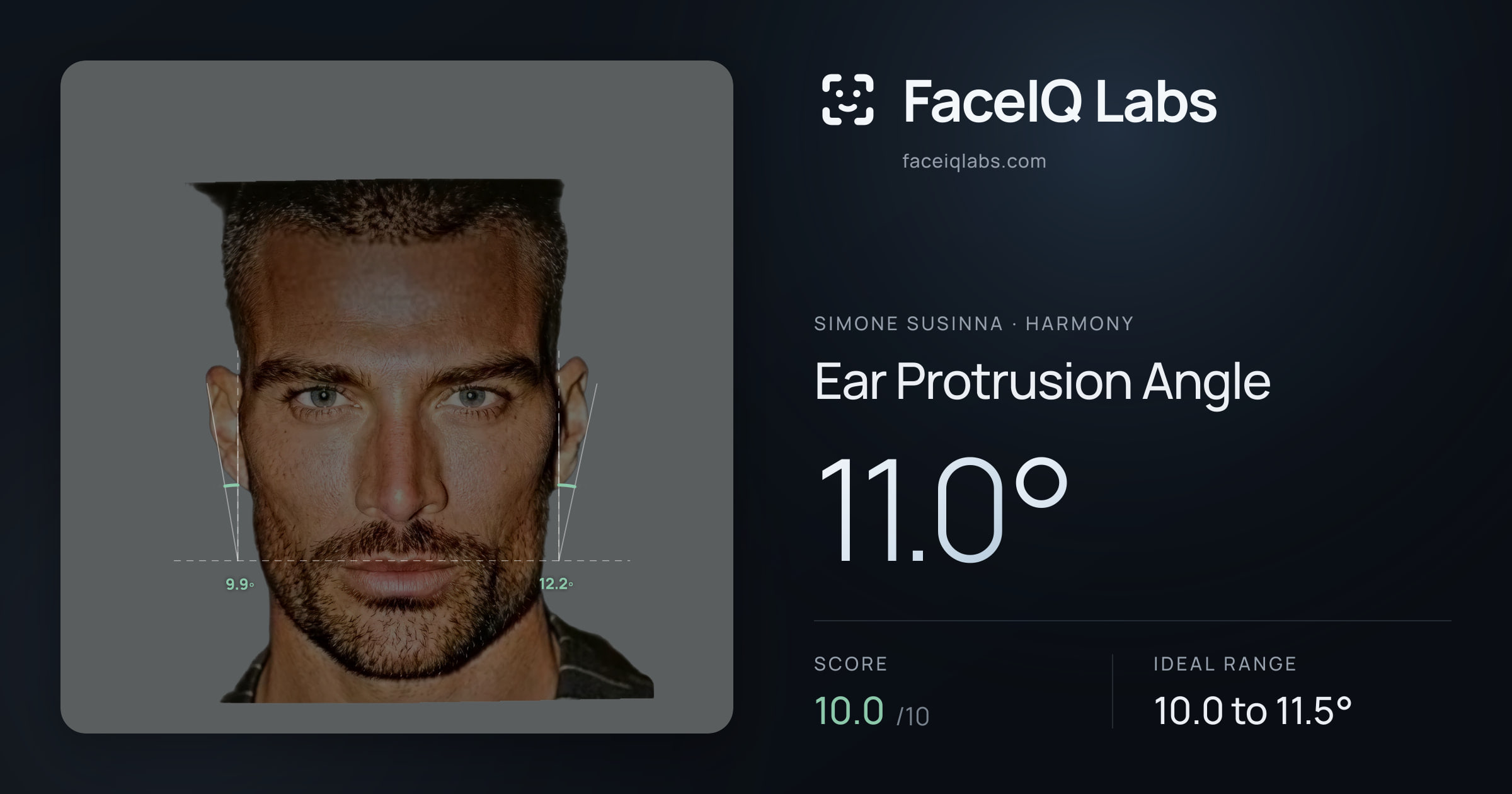 Simone Susinna Ear Protrusion Angle: 11.0°, drawn on the photo