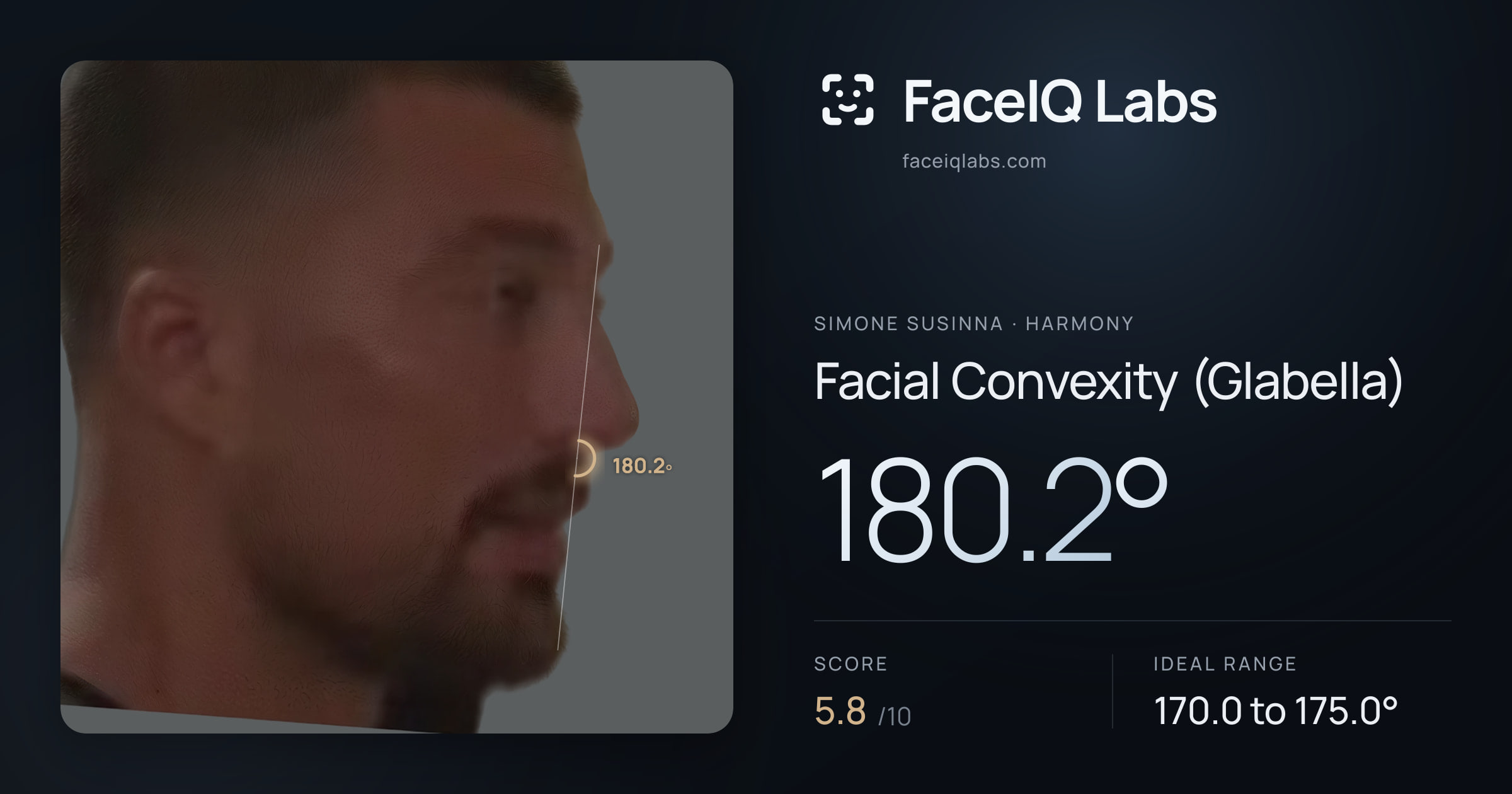 Simone Susinna Facial Convexity (Glabella): 180.2°, drawn on the photo