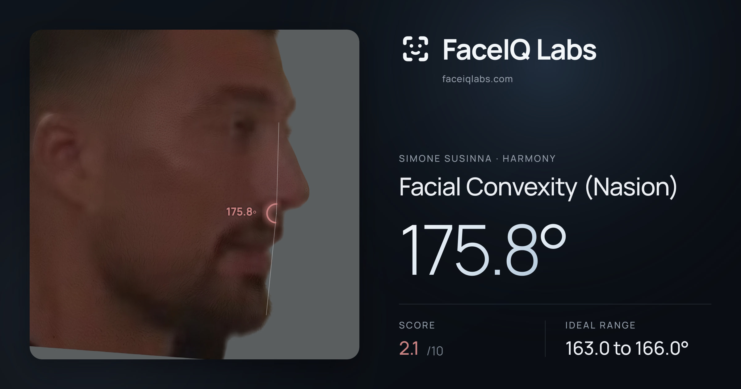 Simone Susinna Facial Convexity (Nasion): 175.8°, drawn on the photo
