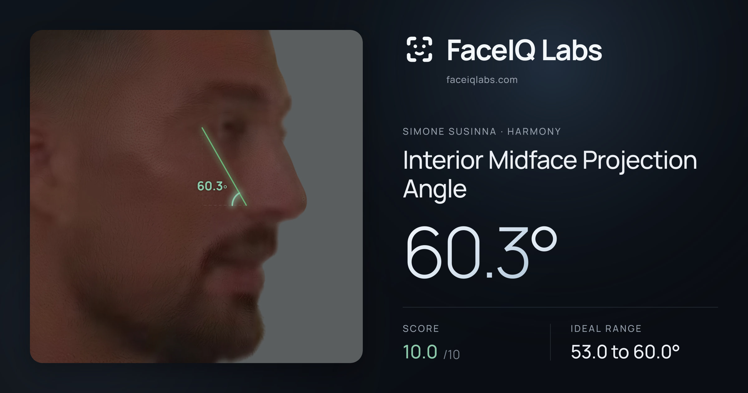 Simone Susinna Interior Midface Projection Angle: 60.3°, drawn on the photo