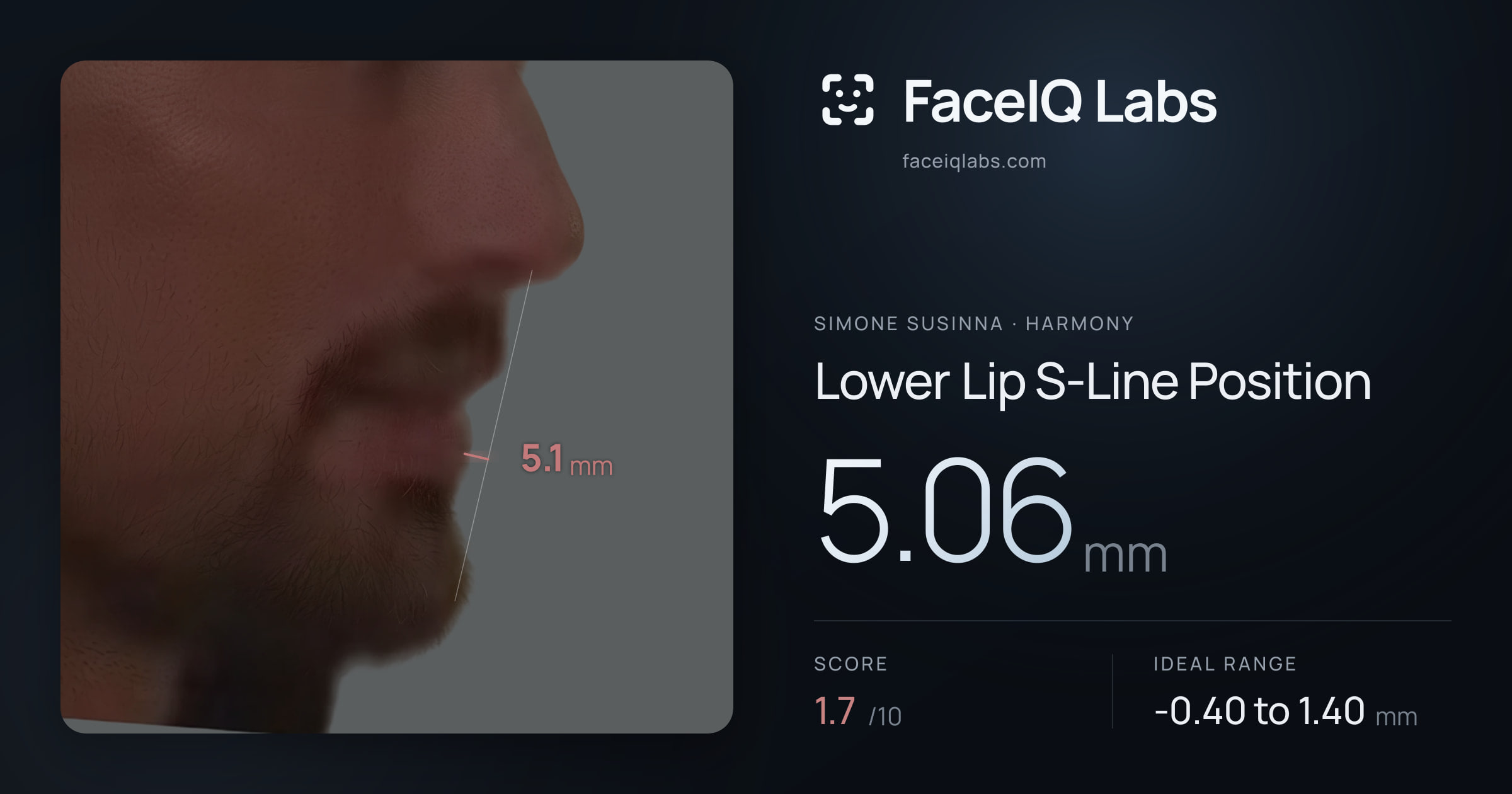 Simone Susinna Lower Lip S-Line Position: 5.06mm, drawn on the photo