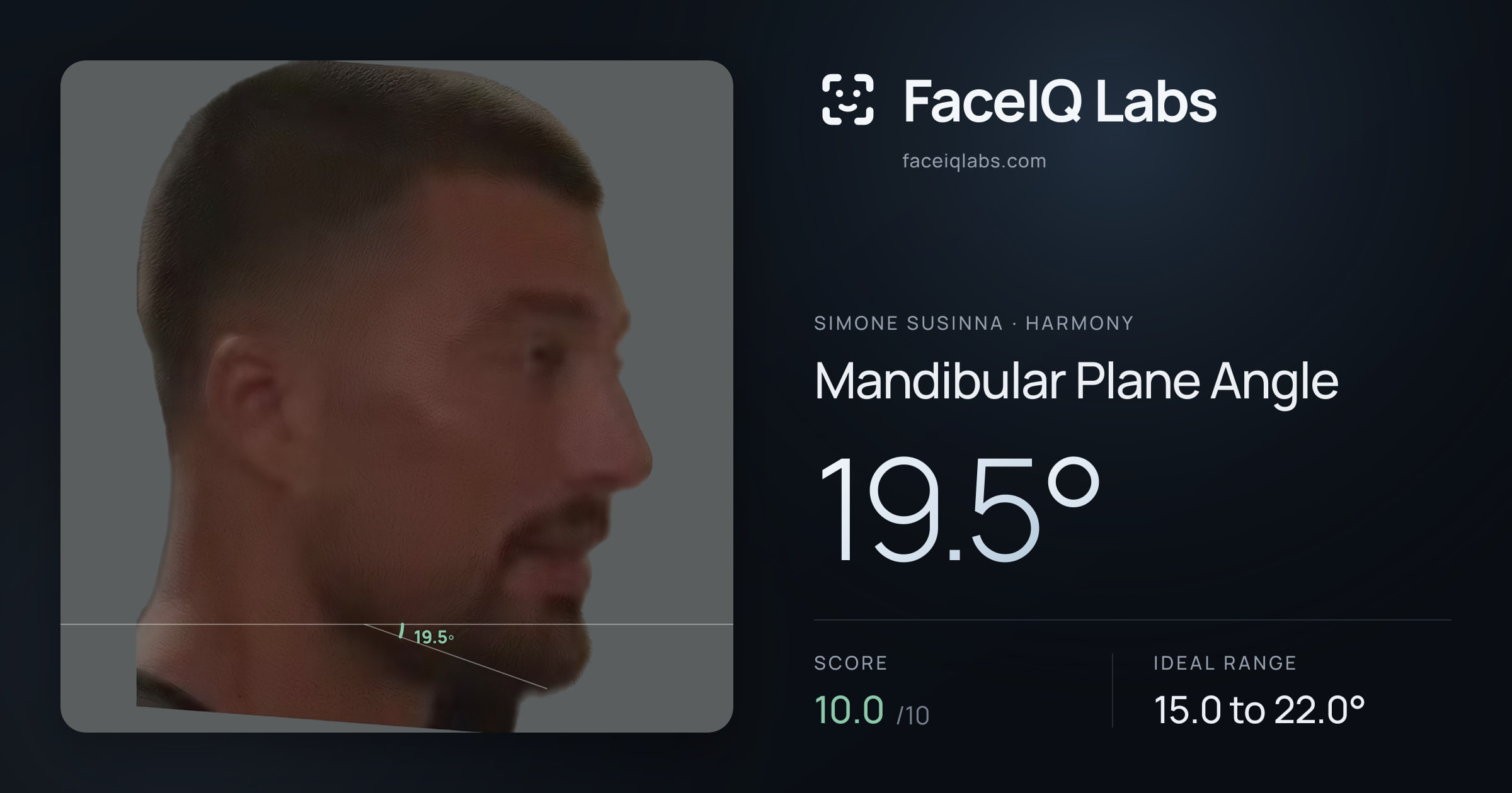 Simone Susinna Mandibular Plane Angle: 19.5°, drawn on the photo
