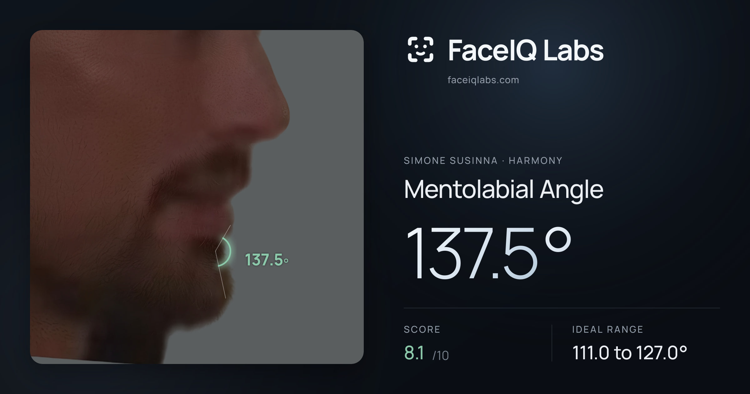 Simone Susinna Mentolabial Angle: 137.5°, drawn on the photo