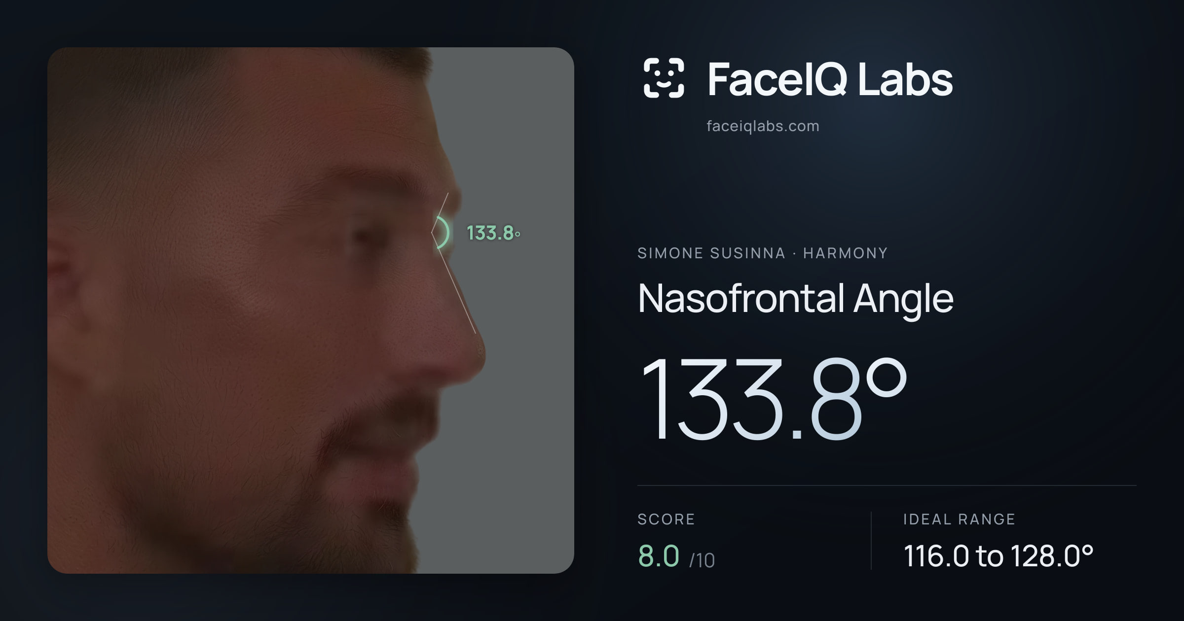 Simone Susinna Nasofrontal Angle: 133.8°, drawn on the photo
