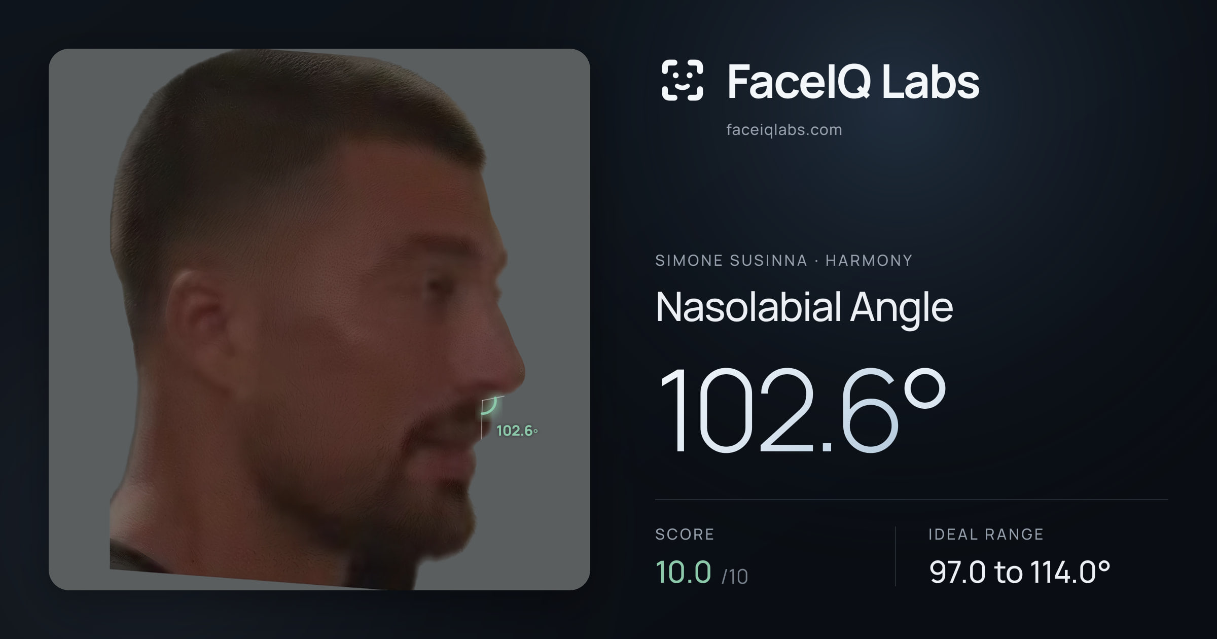 Simone Susinna Nasolabial Angle: 102.6°, drawn on the photo