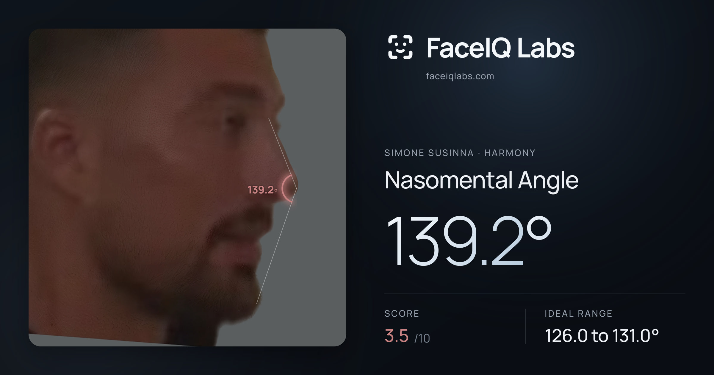 Simone Susinna Nasomental Angle: 139.2°, drawn on the photo