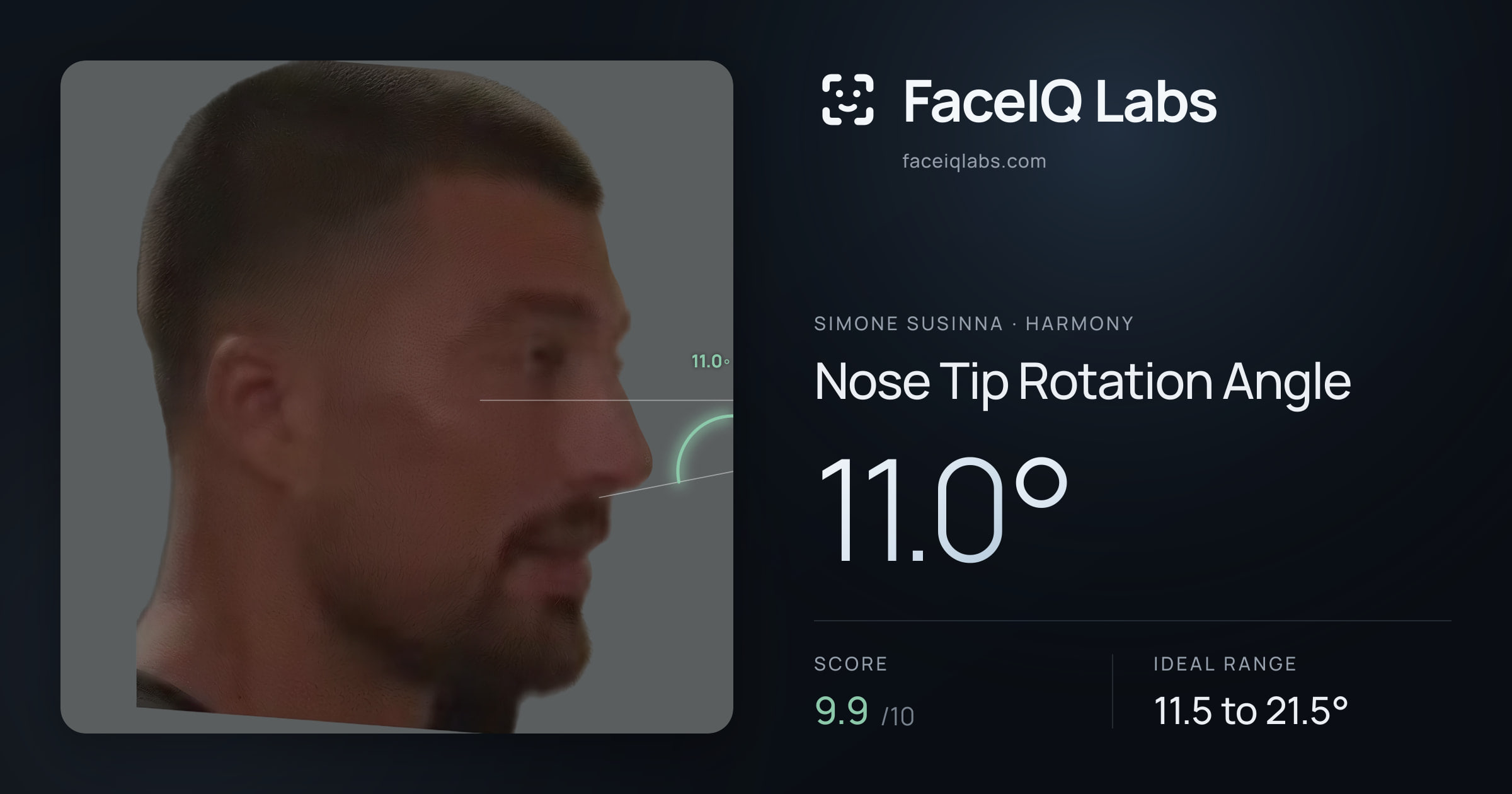 Simone Susinna Nose Tip Rotation Angle: 11.0°, drawn on the photo