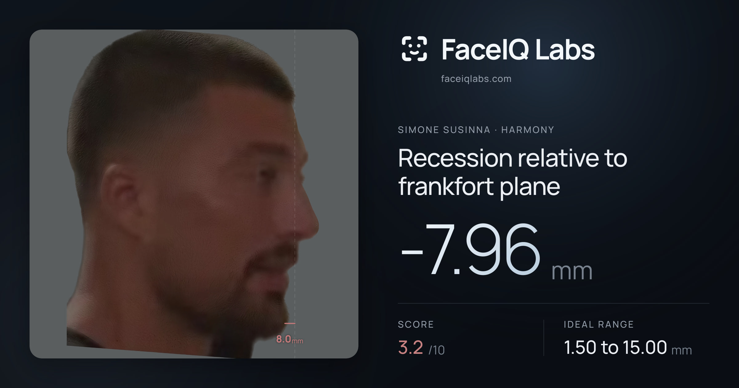 Simone Susinna Recession relative to frankfort plane: -7.96mm, drawn on the photo