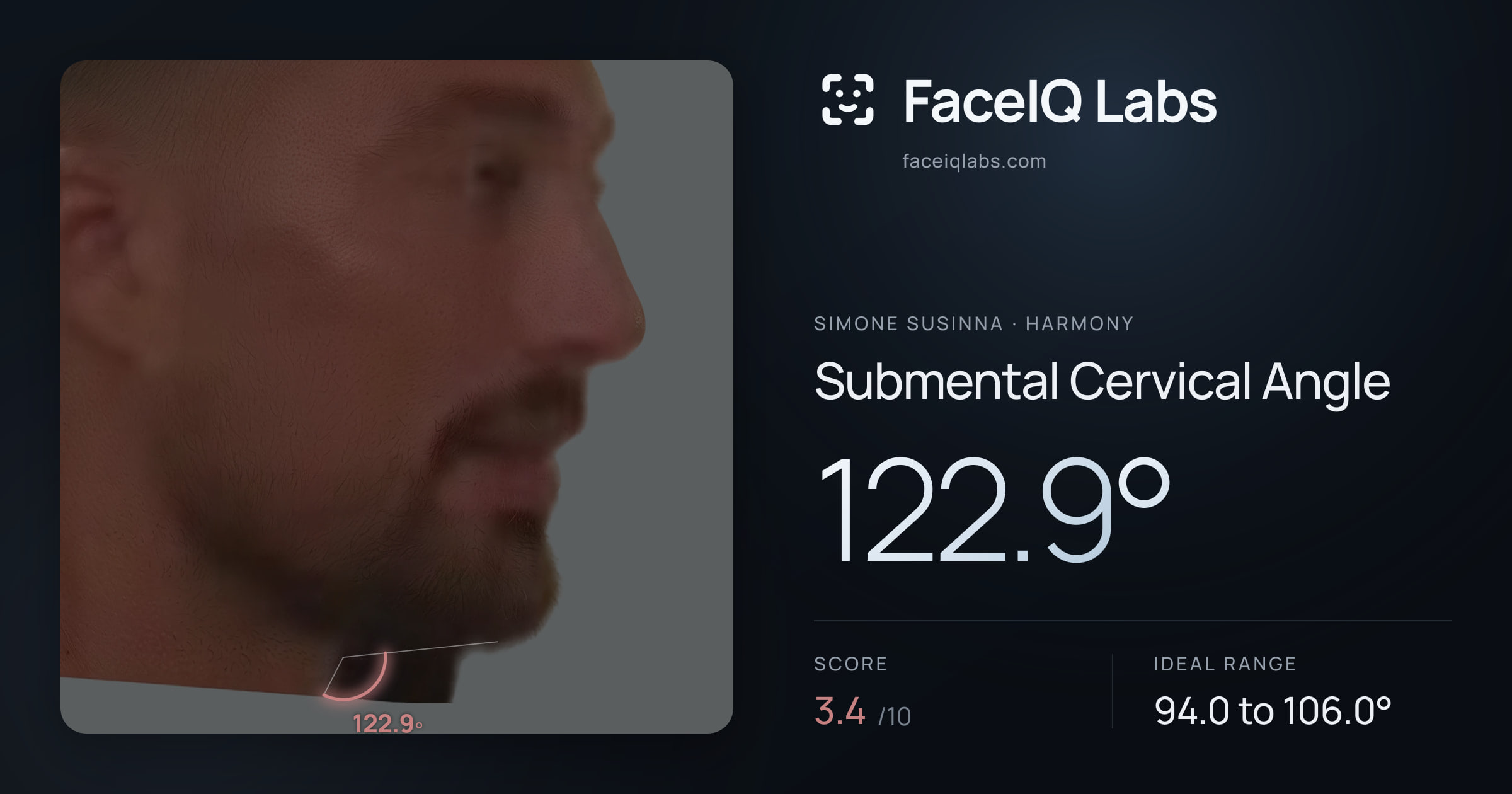Simone Susinna Submental Cervical Angle: 122.9°, drawn on the photo
