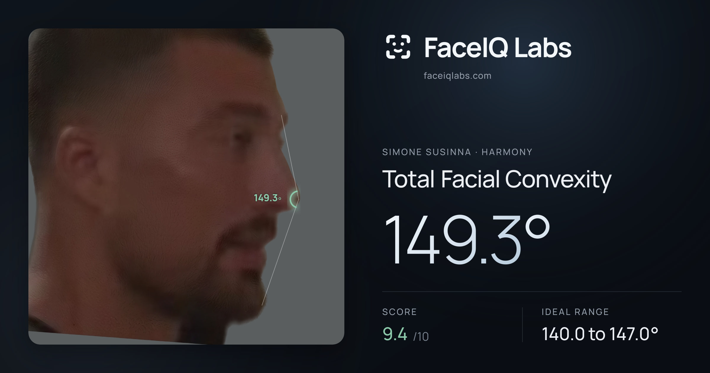 Simone Susinna Total Facial Convexity: 149.3°, drawn on the photo