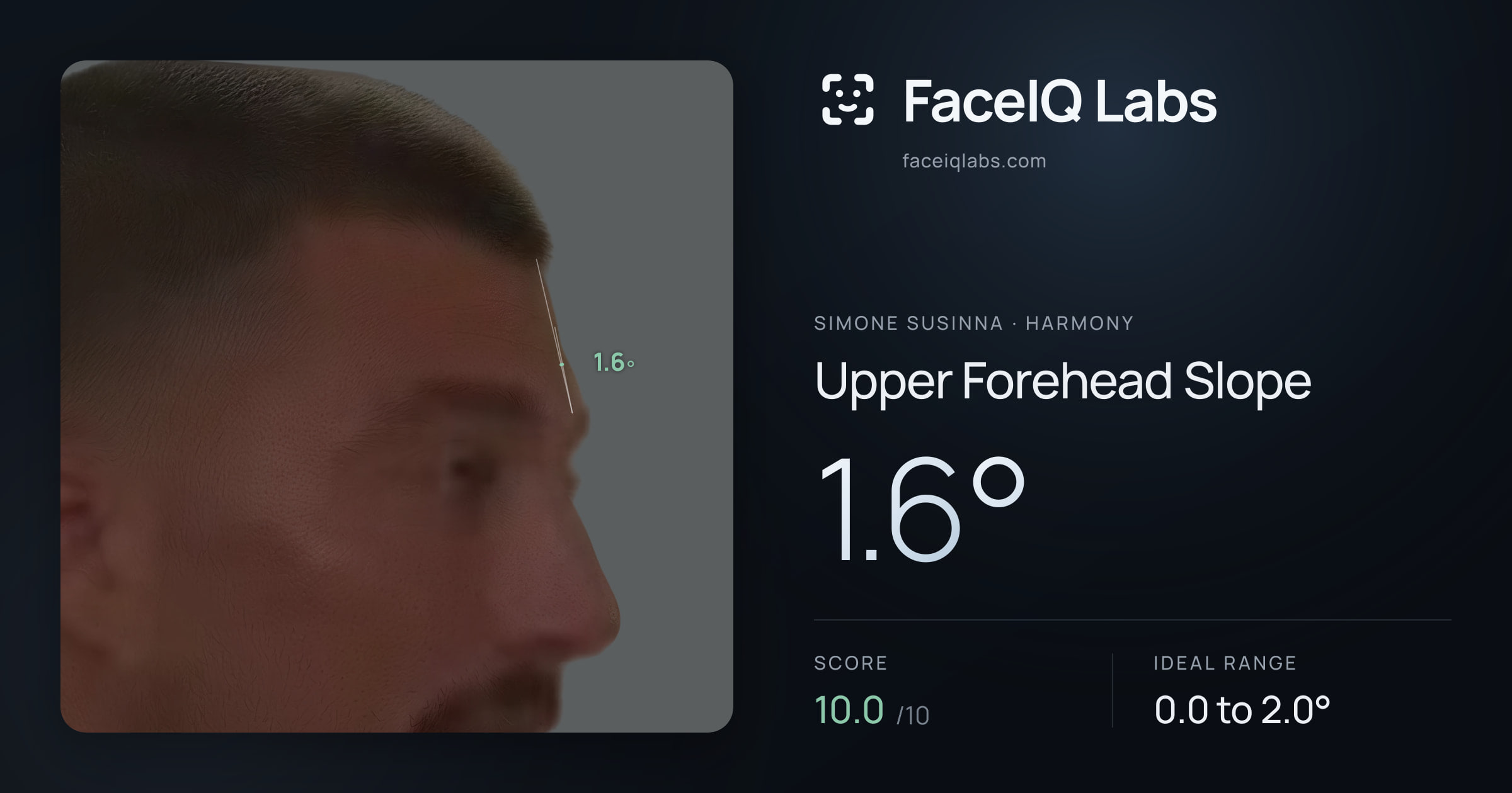 Simone Susinna Upper Forehead Slope: 1.6°, drawn on the photo