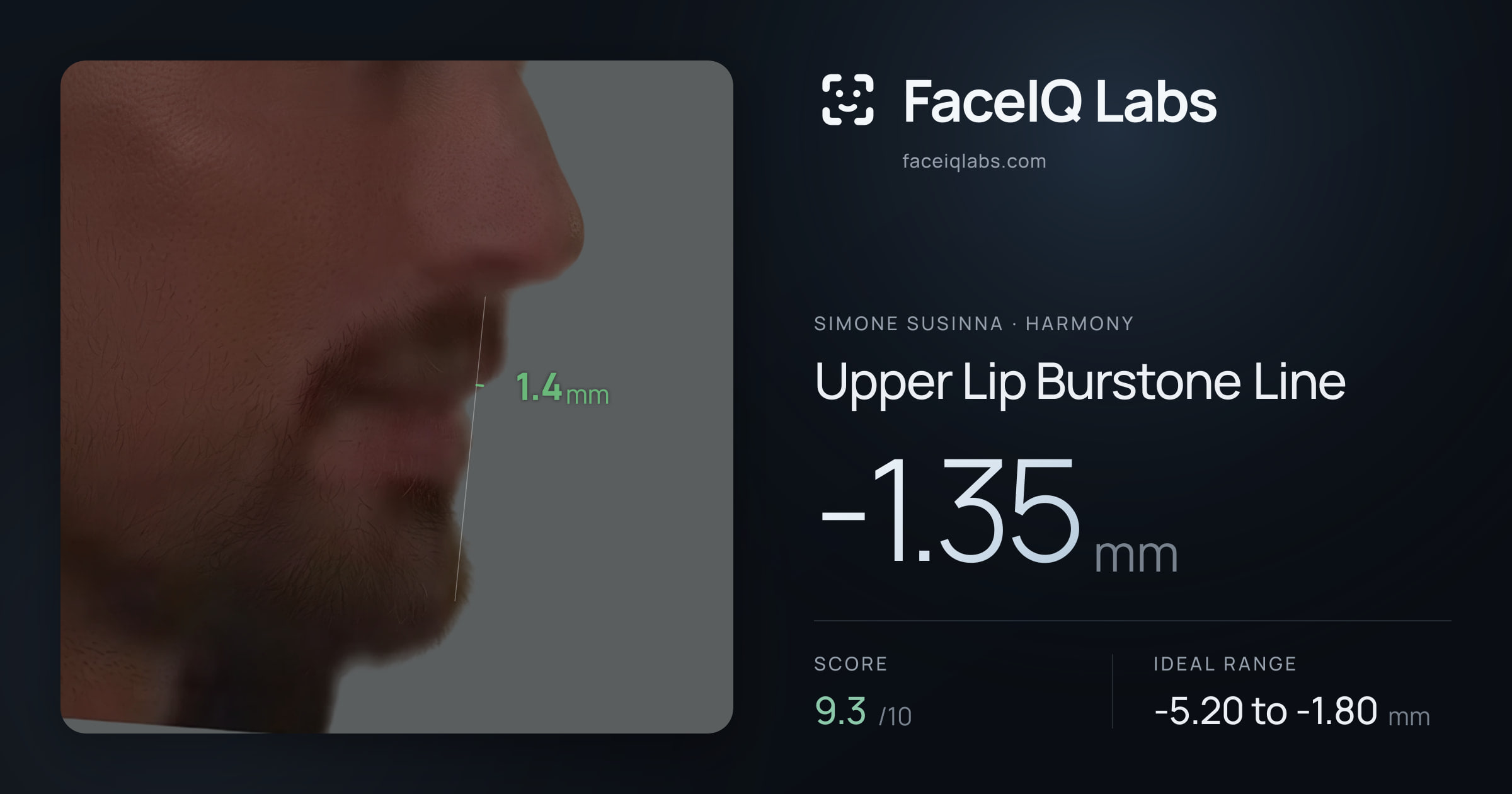 Simone Susinna Upper Lip Burstone Line: -1.35mm, drawn on the photo