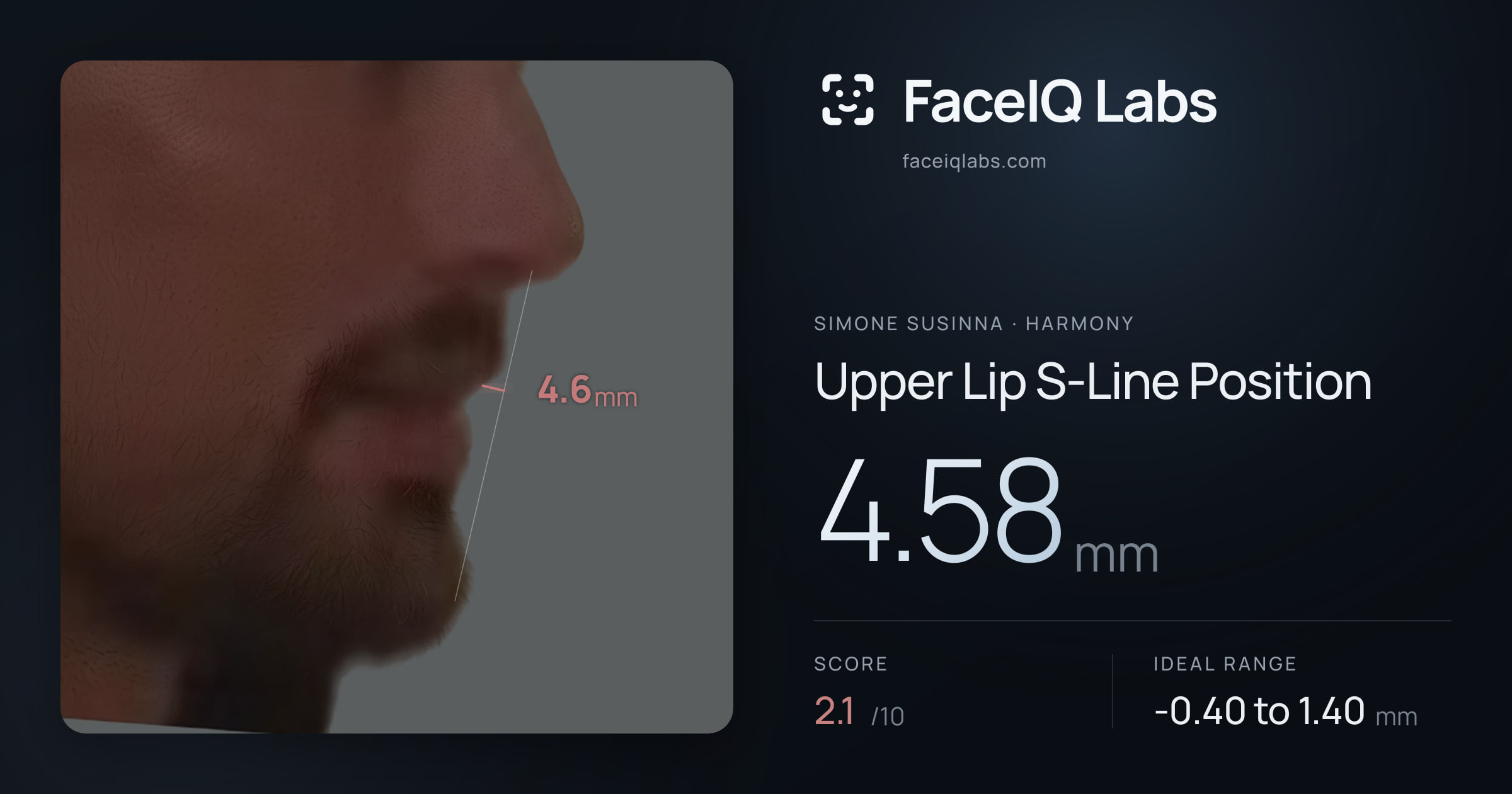 Simone Susinna Upper Lip S-Line Position: 4.58mm, drawn on the photo