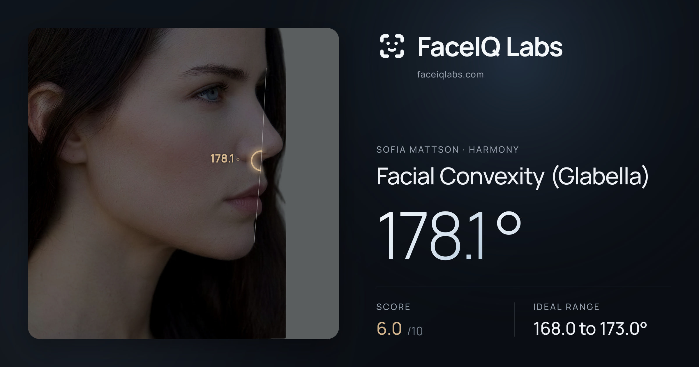 Sofia Mattson Facial Convexity (Glabella): 178.1°, drawn on the photo