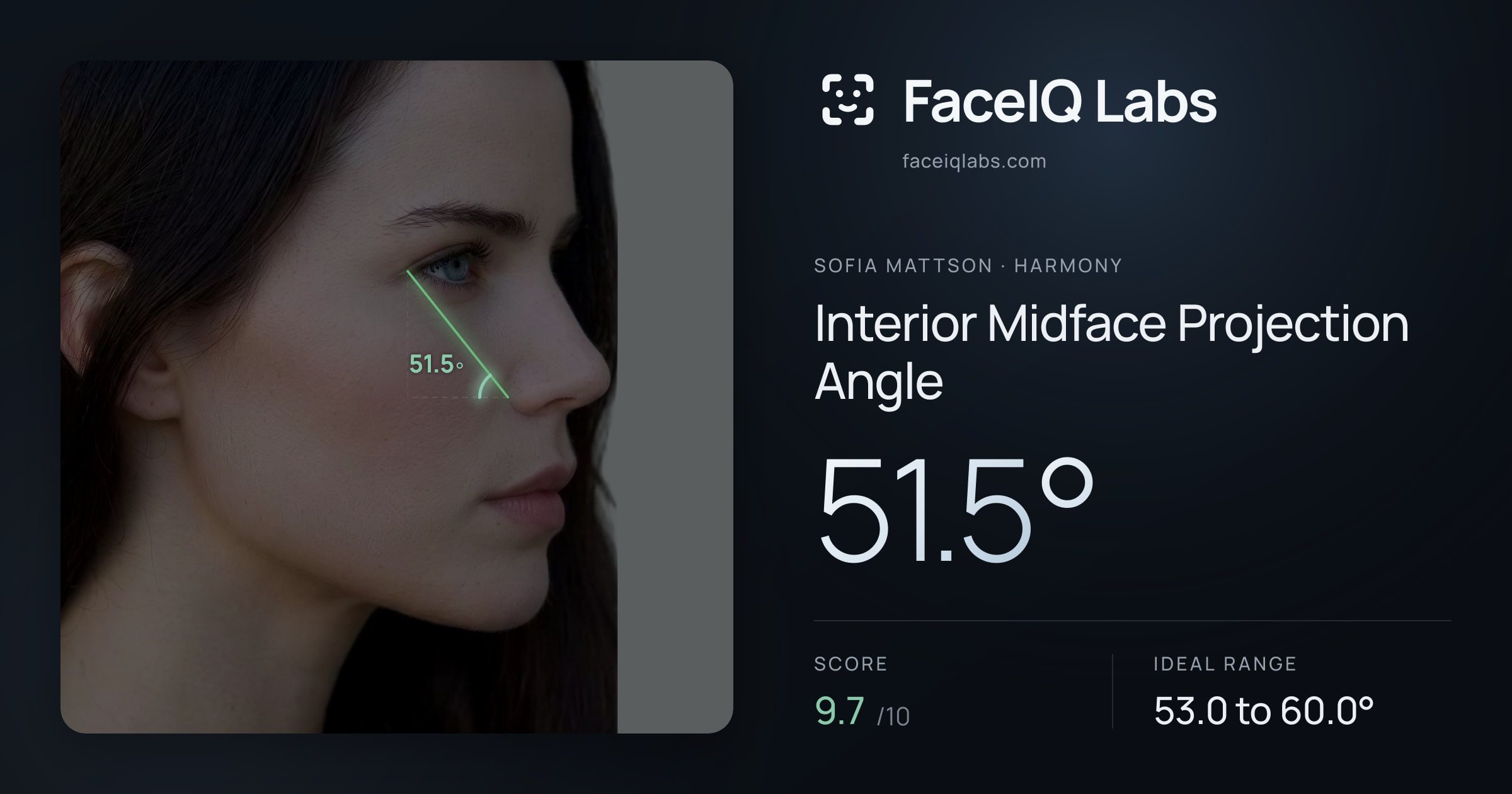 Sofia Mattson Interior Midface Projection Angle: 51.5°, drawn on the photo
